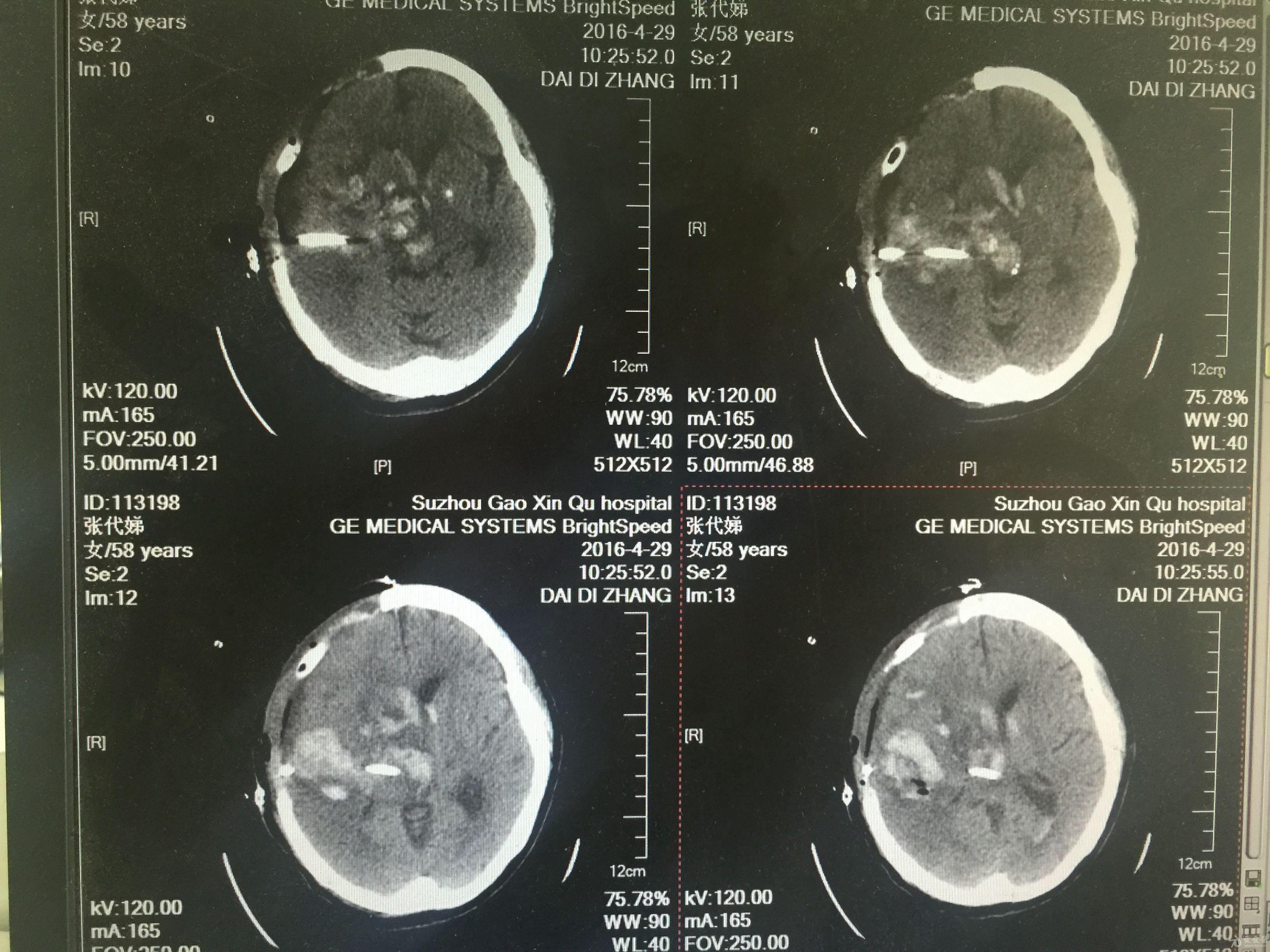 分享一例自发性颞顶叶脑出血伴迟发脑干出血原创