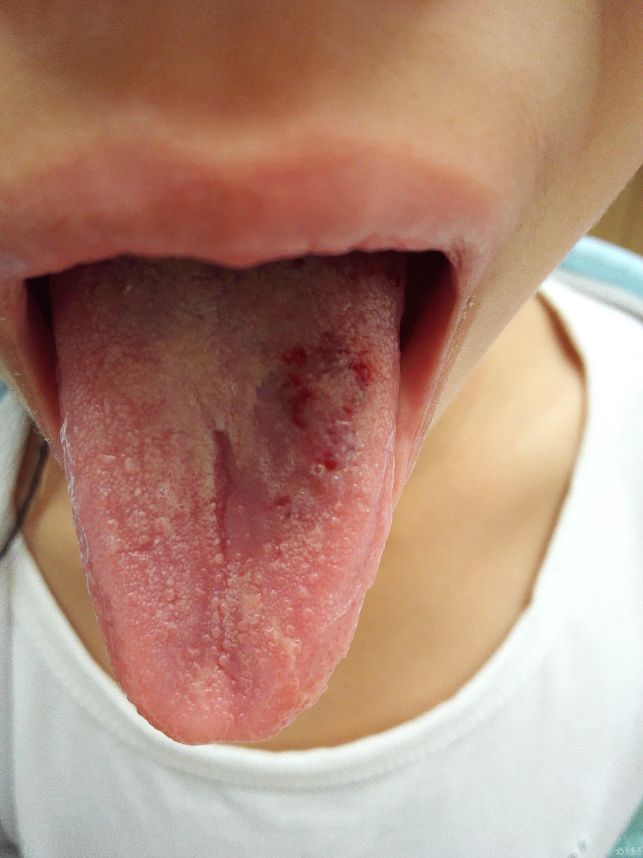 儿童舌头血管瘤