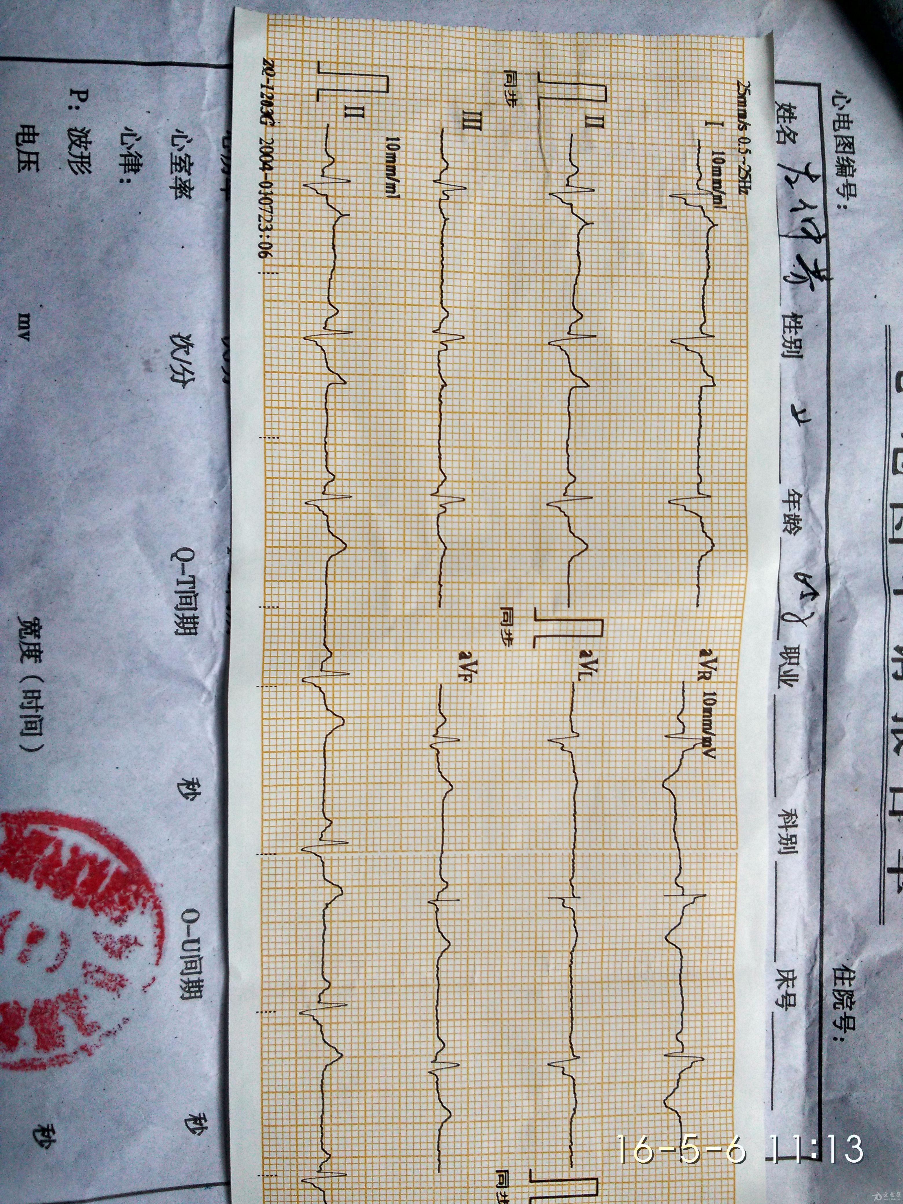 这是一位体检的女性患者的心电图