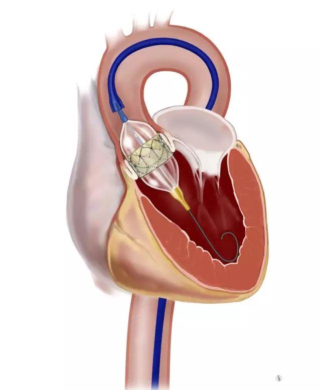 主动脉瓣狭窄怎么办 心脏和胸部外科讨论版 爱爱医医学论坛