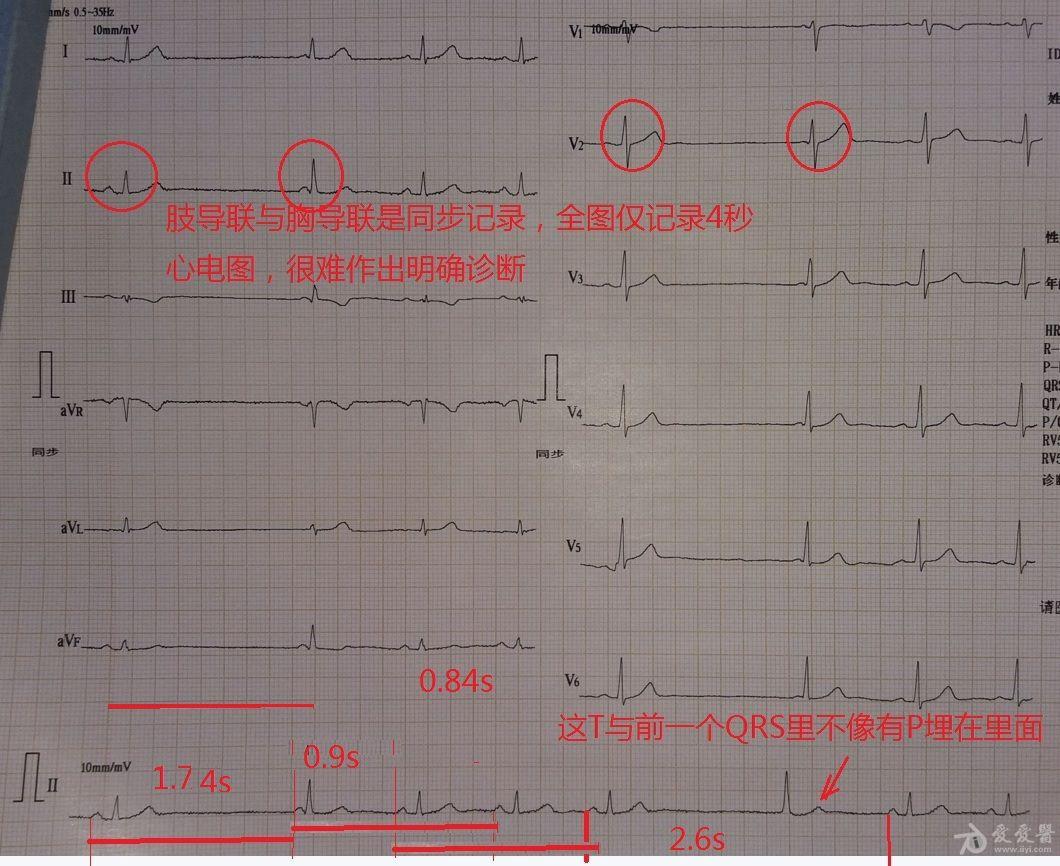 二导联心电图波形图片