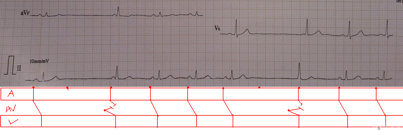 窦房传导阻滞心电图图片