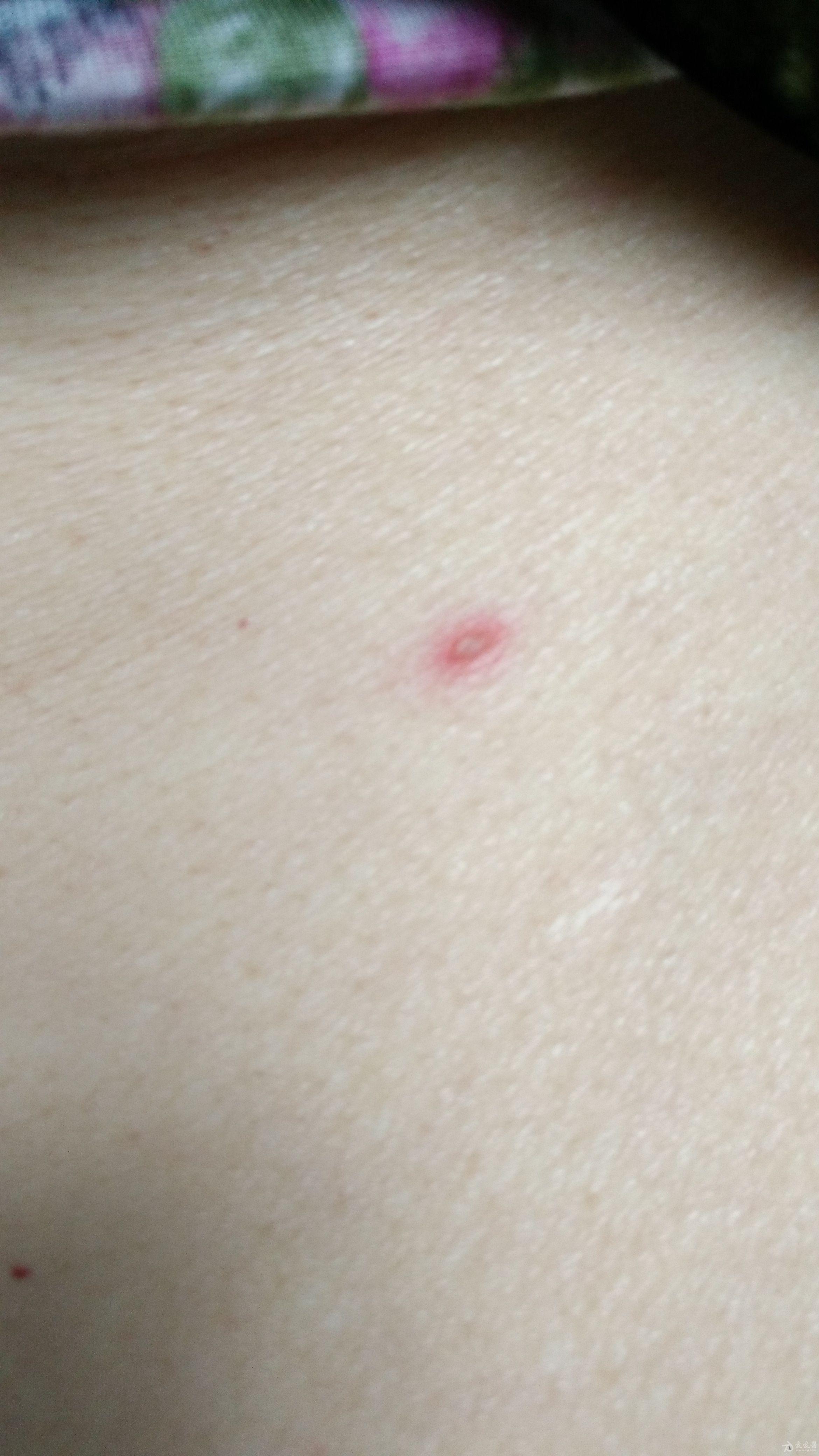 一例严重带状疱疹病例 合并躯体单纯疱疹病例 附图片