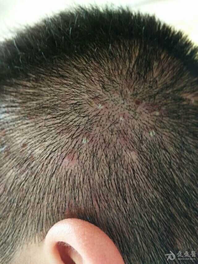 有奖猜图积分大派送y秃发性毛囊炎