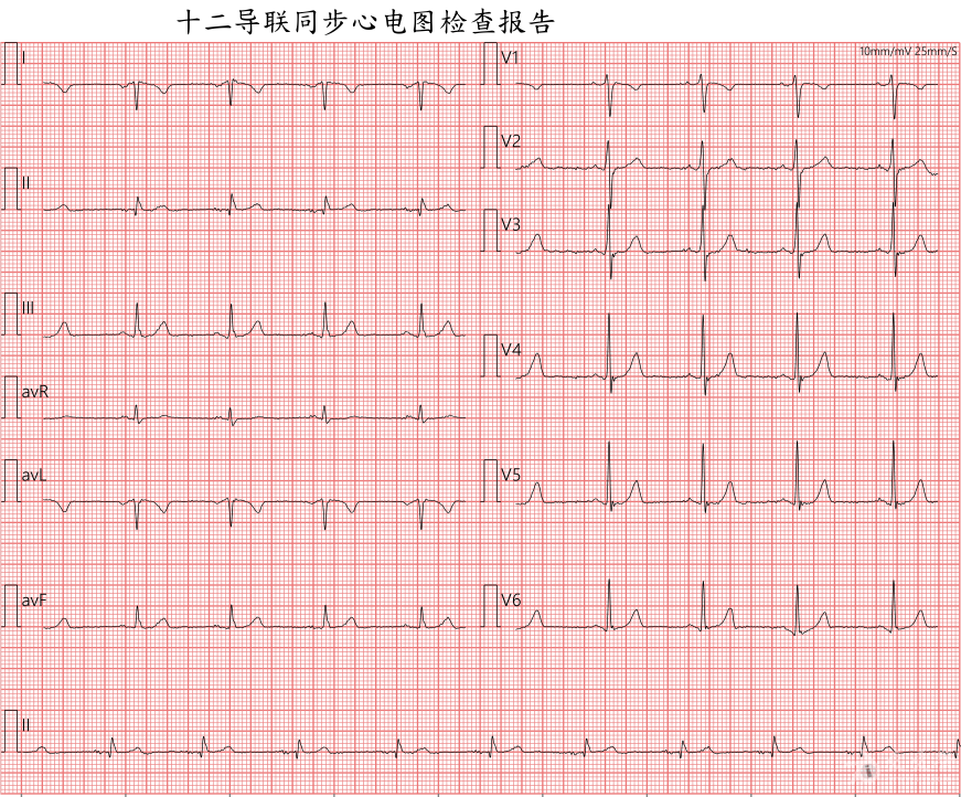 电轴右偏的心电图图片