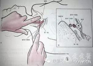 中心静脉穿刺置管可造成严重并发症