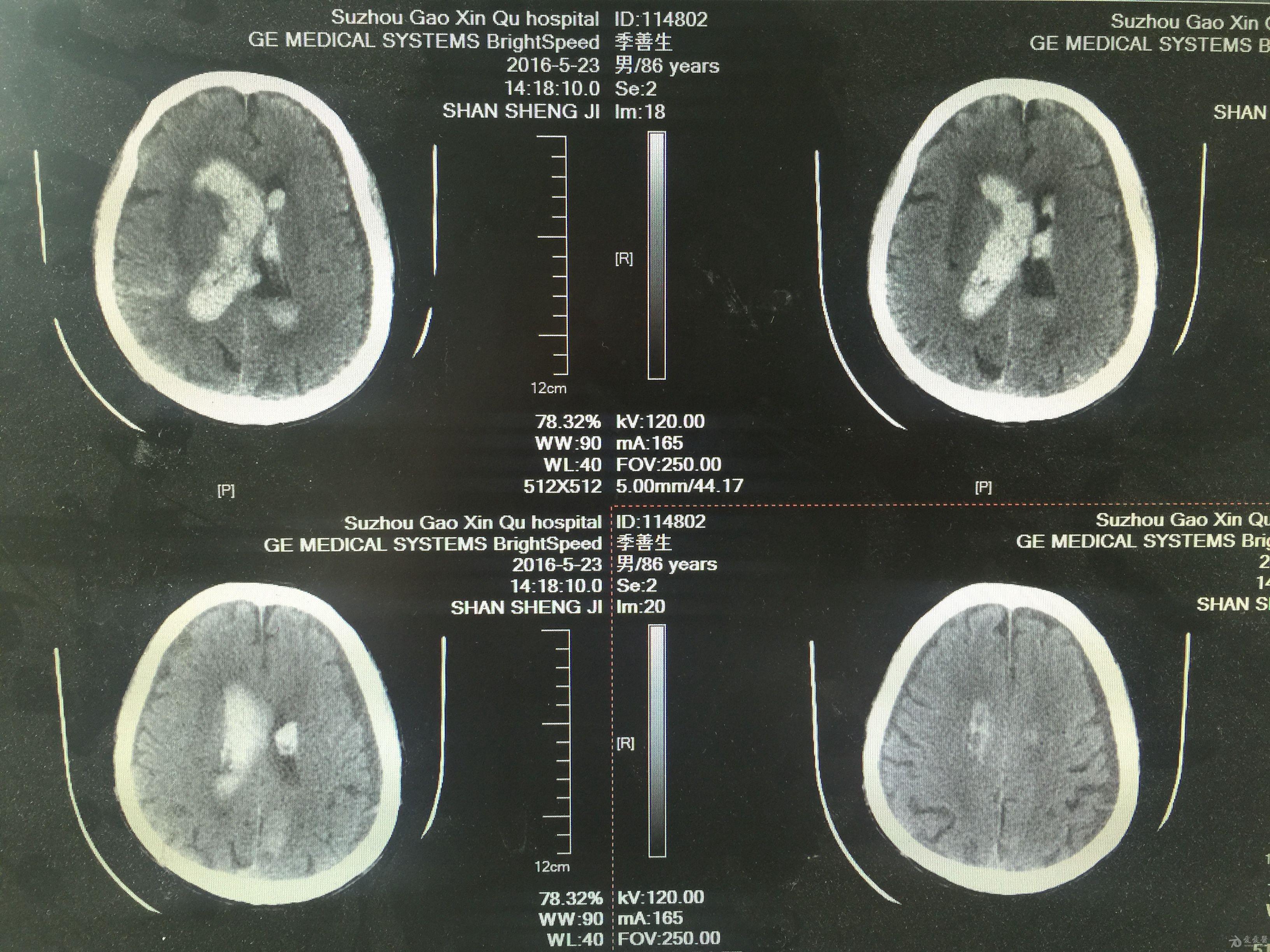 分享一例基底节出血脑室铸型病例(原创) - 神经外科专业讨论版 - 爱爱