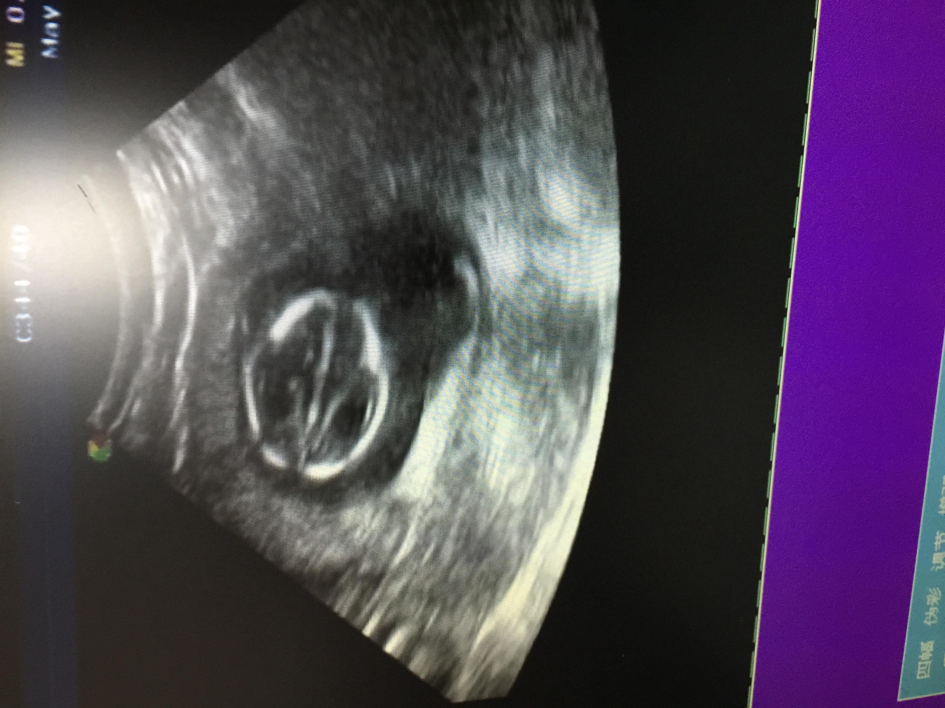 这个胎儿大脑有问题吗