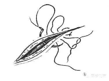 详解各种外科缝合法,图文并茂!