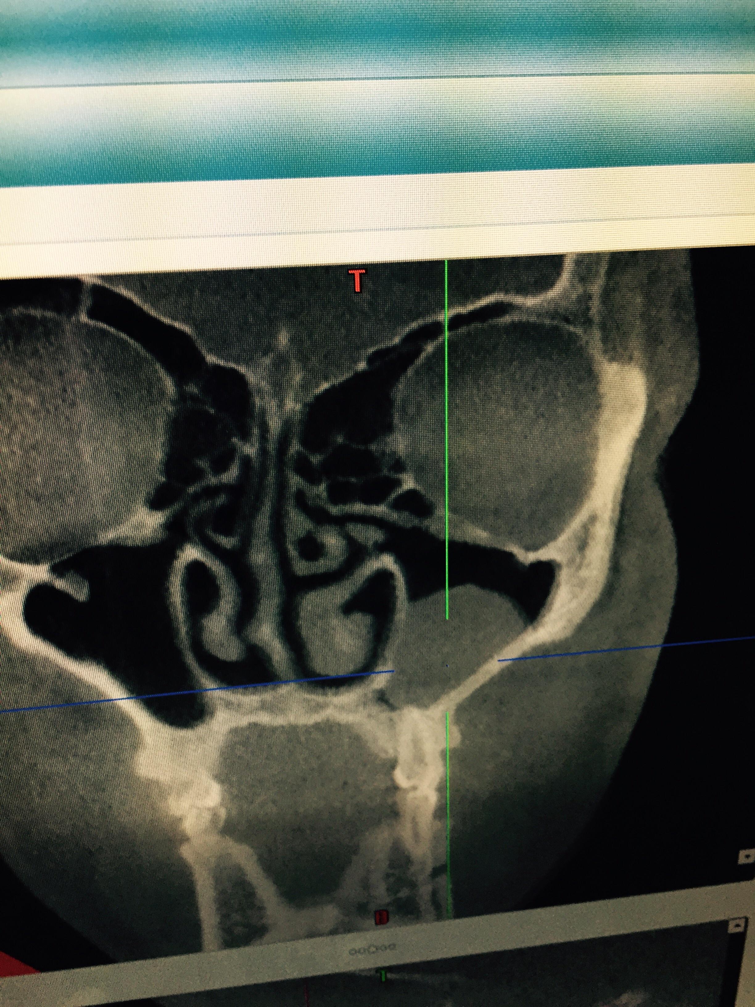 左侧上颌窦囊肿图片图片