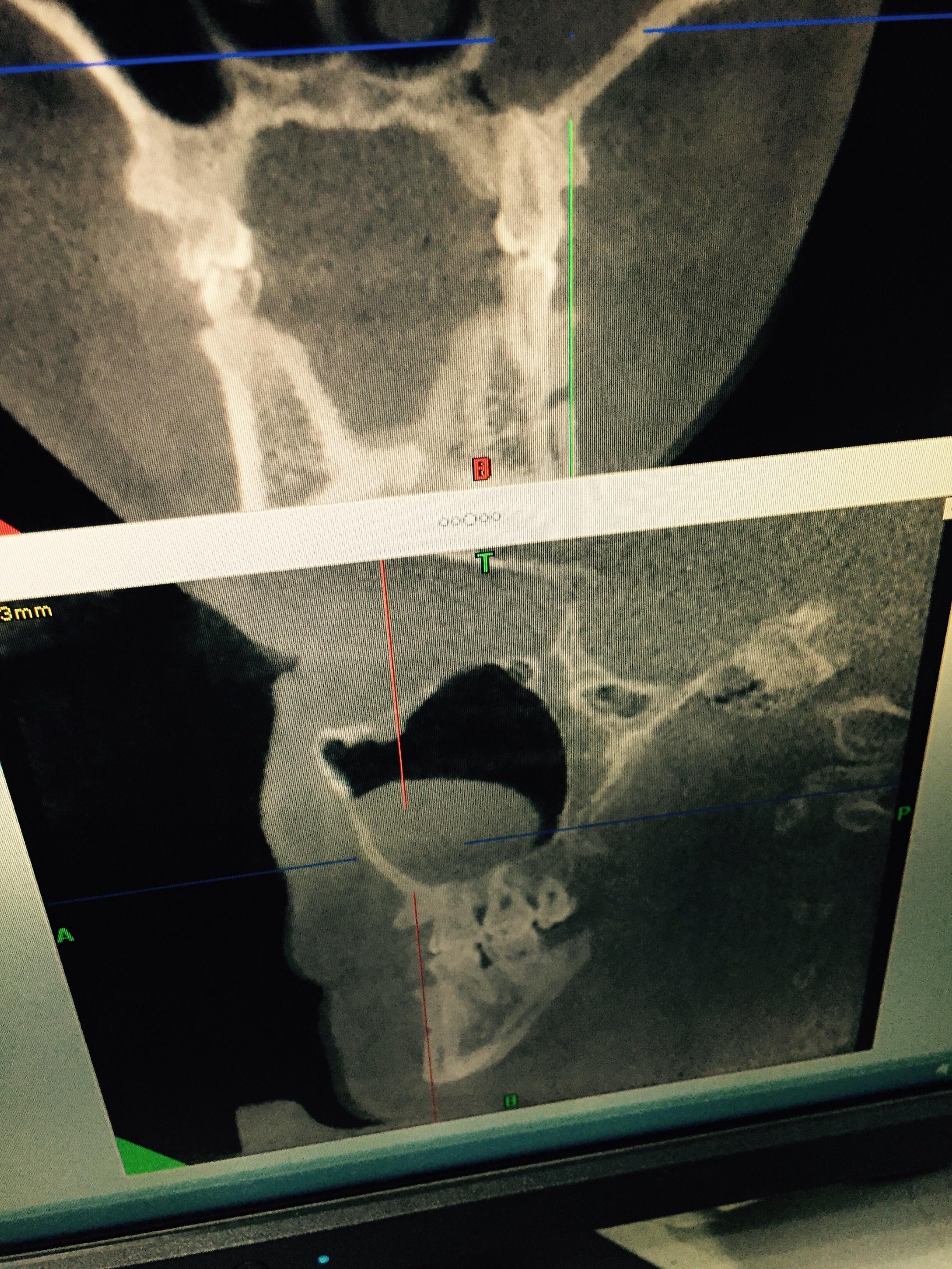 左侧上颌窦囊肿图片图片