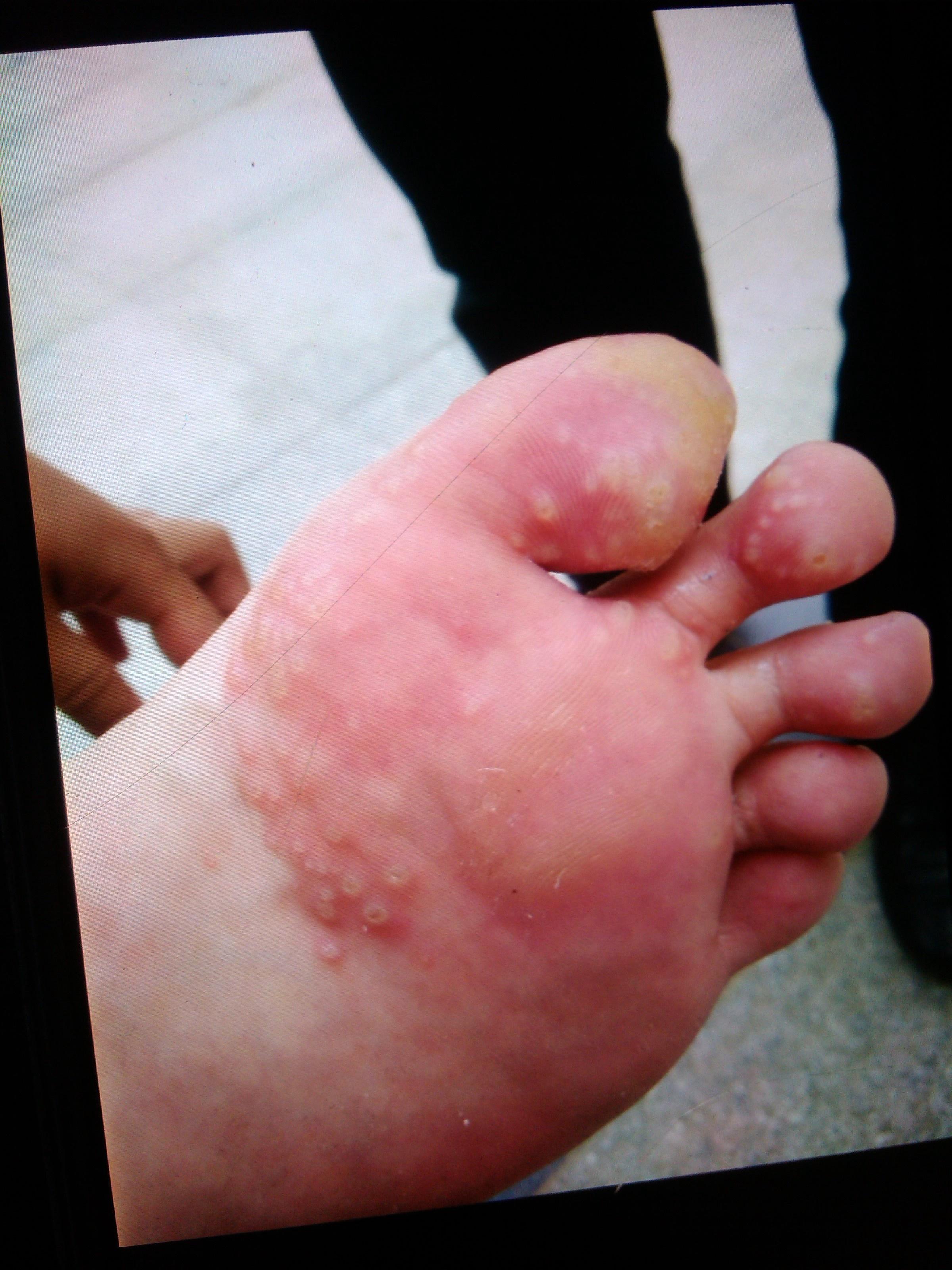 不象脚癣?求助老师们!急