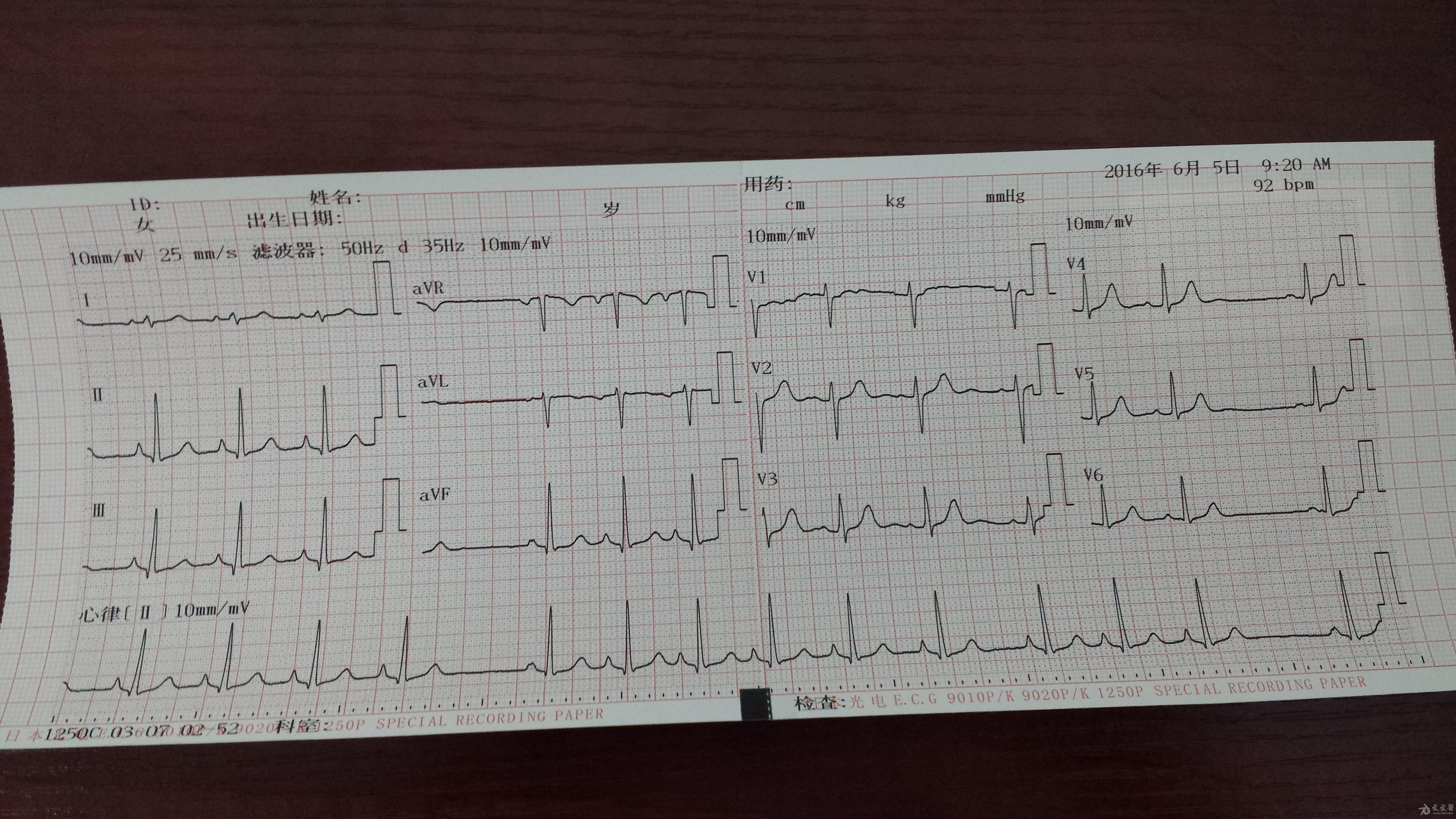 这份心电图是女性25岁入职体检可诊断1窦性心律不齐22度2型窦房传导阻