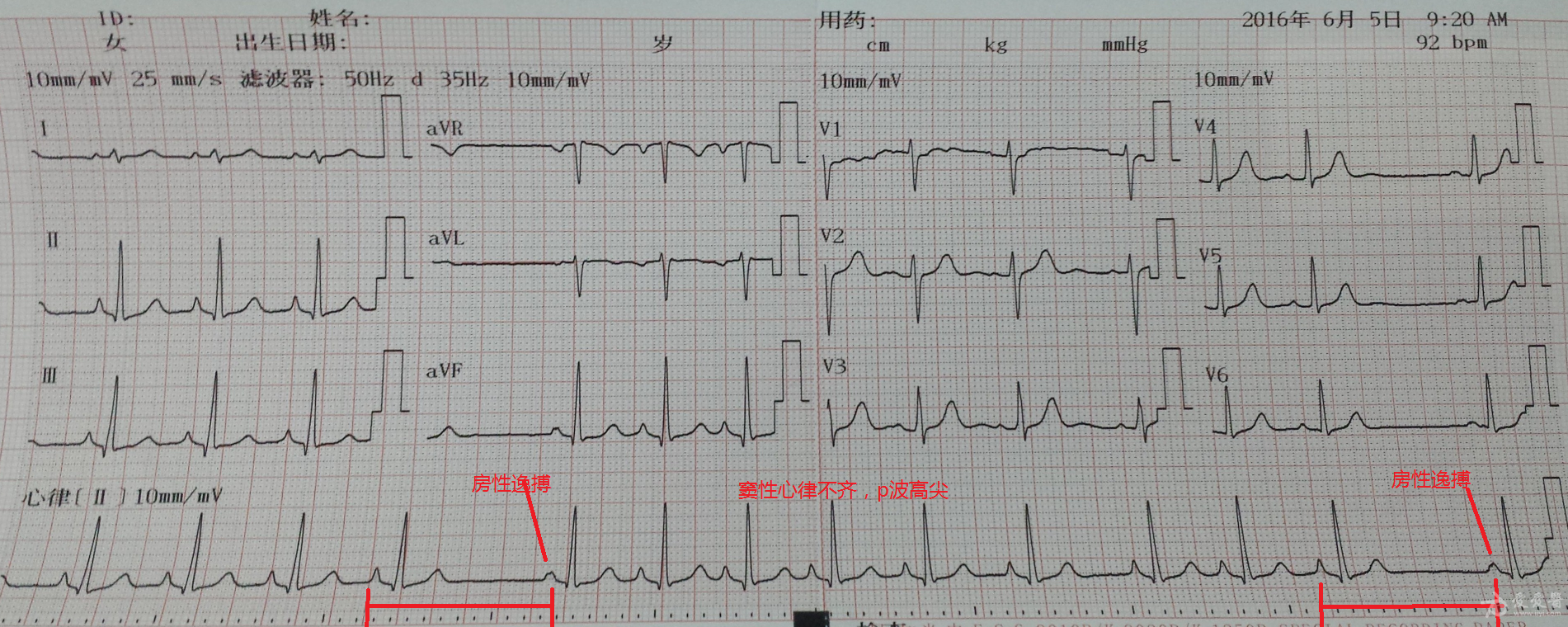 這份心電圖是女性25歲入職體檢可診斷1竇性心律不齊22度2型竇房傳導阻