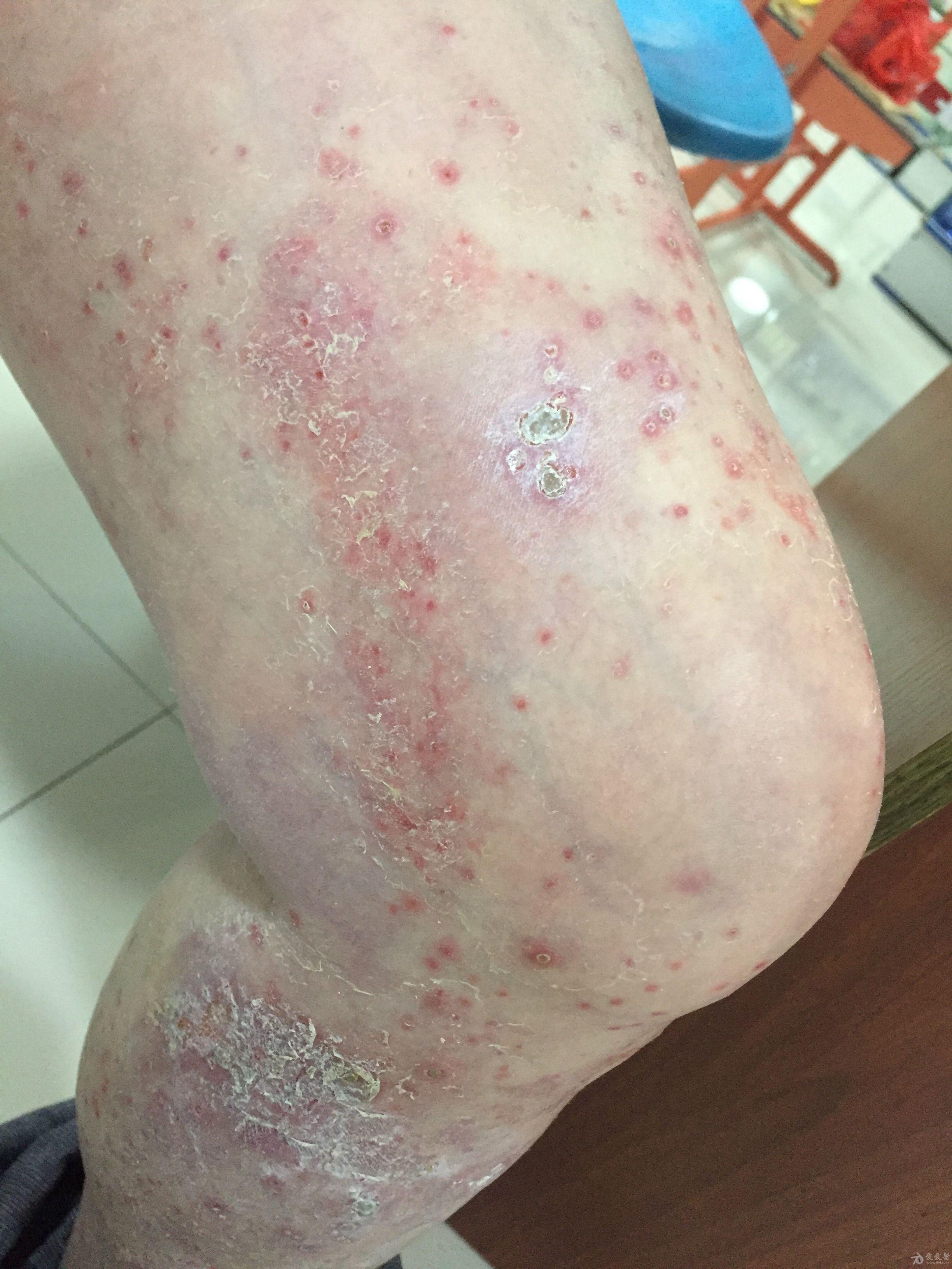 看图说话:腿上红疹,是什么皮肤病?
