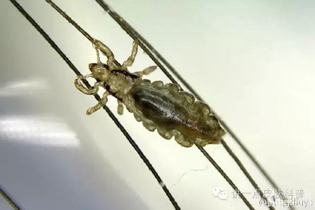 【转帖】头虱和阴虱,还是傻傻分不清吗?