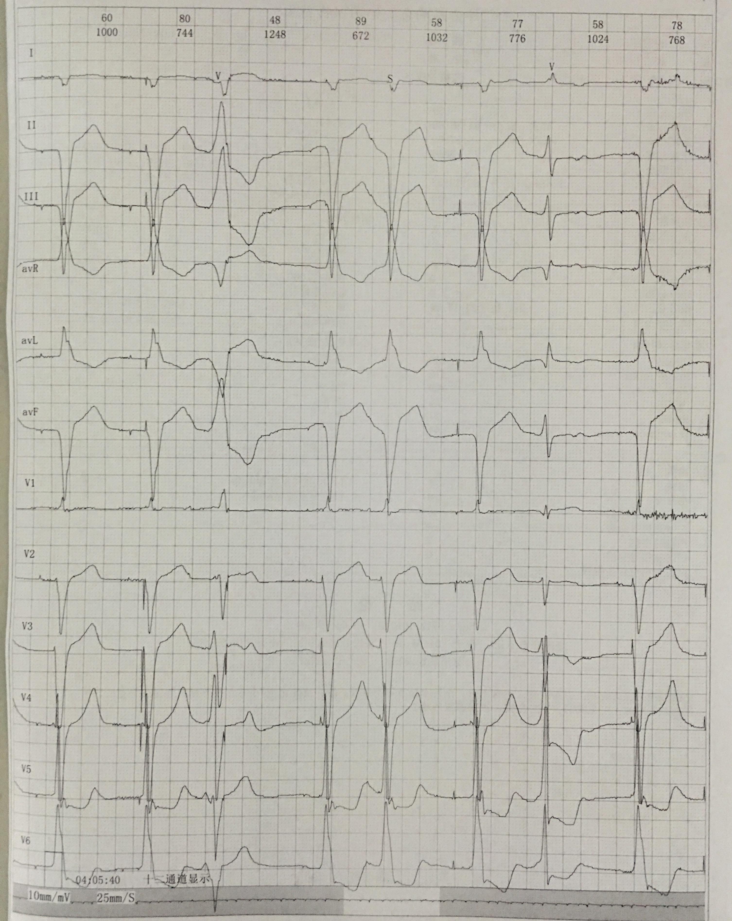 三度传导阻滞心电图图片