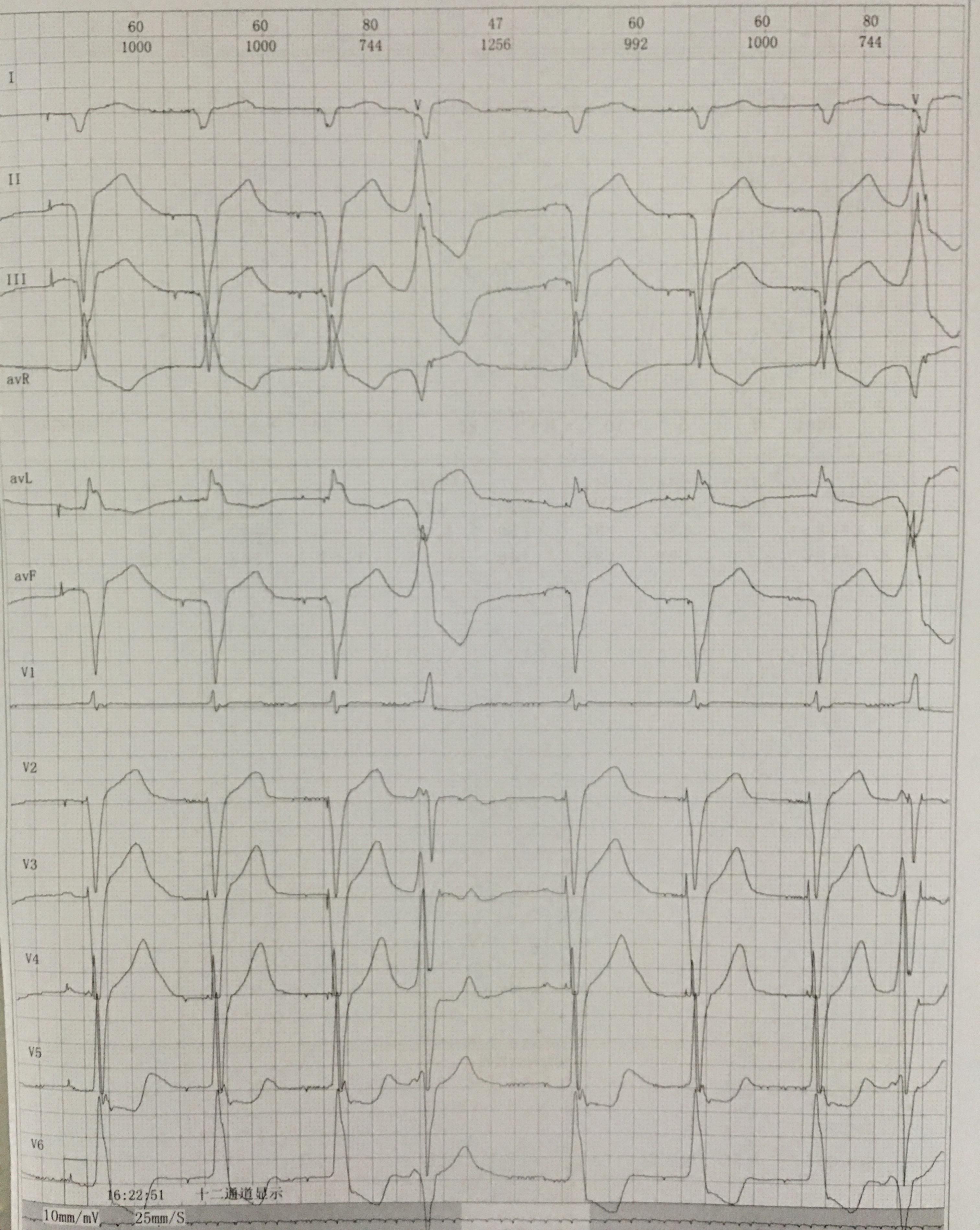 三度传导阻滞心电图图片