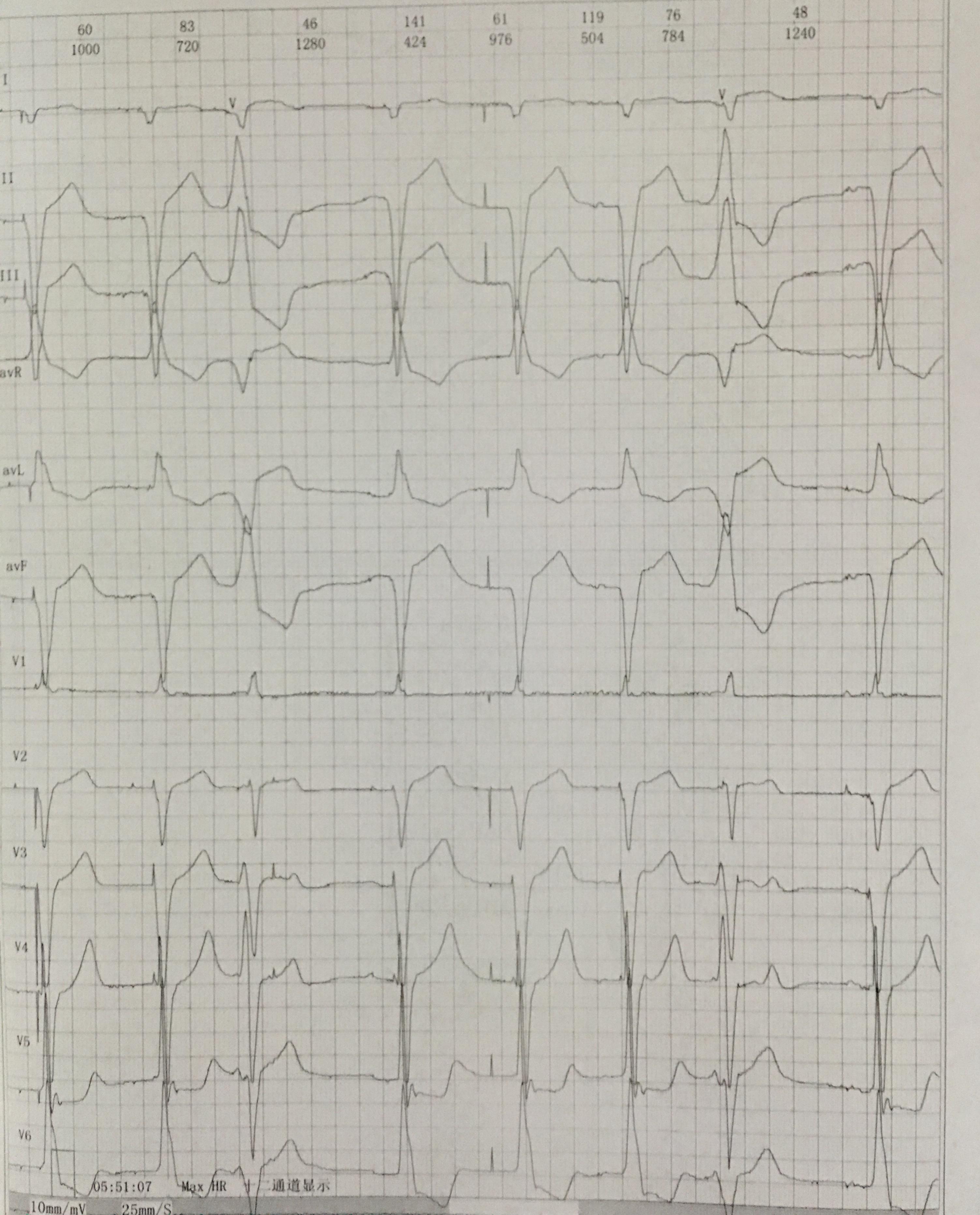 三度传导阻滞心电图图片
