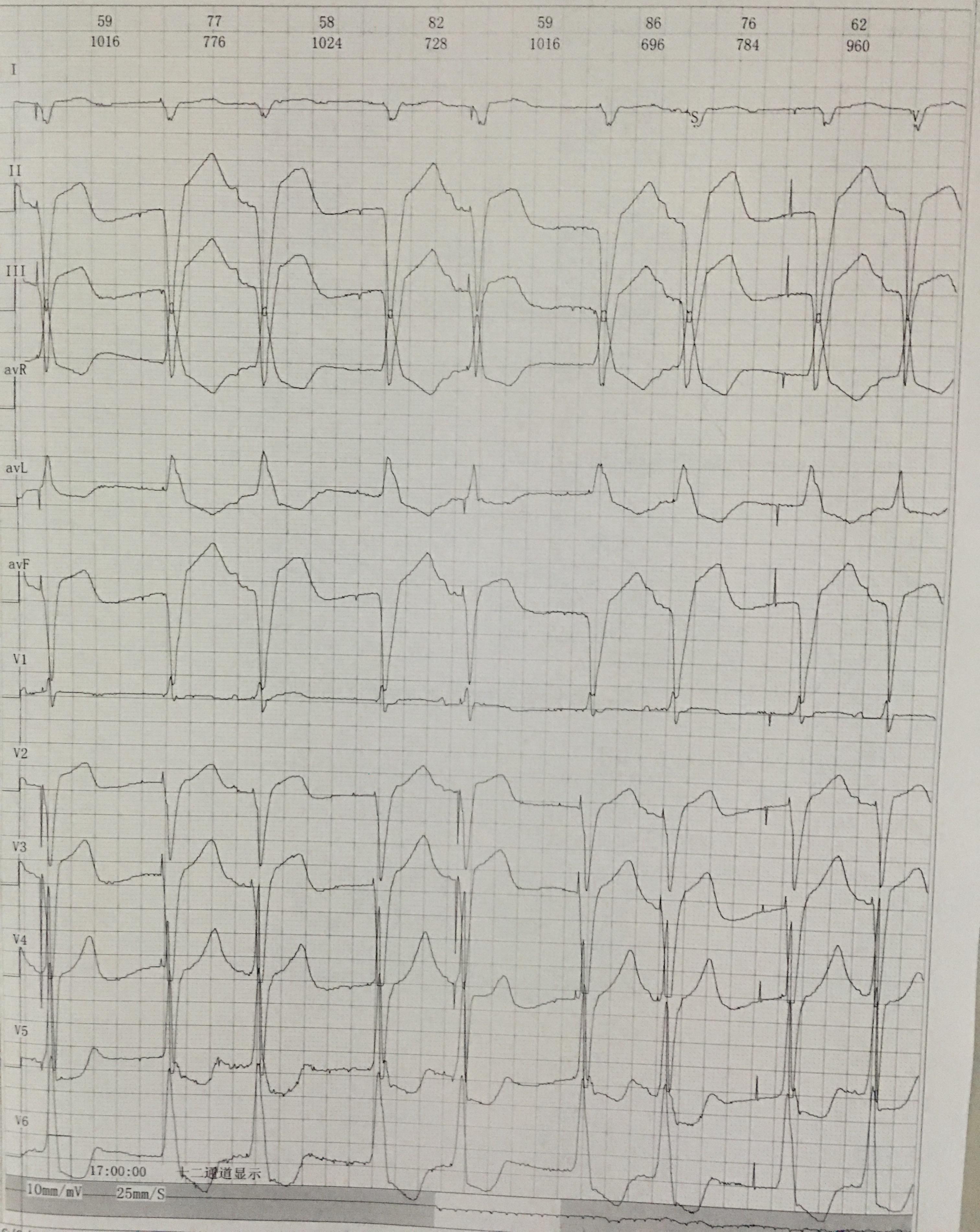 三度传导阻滞心电图图片