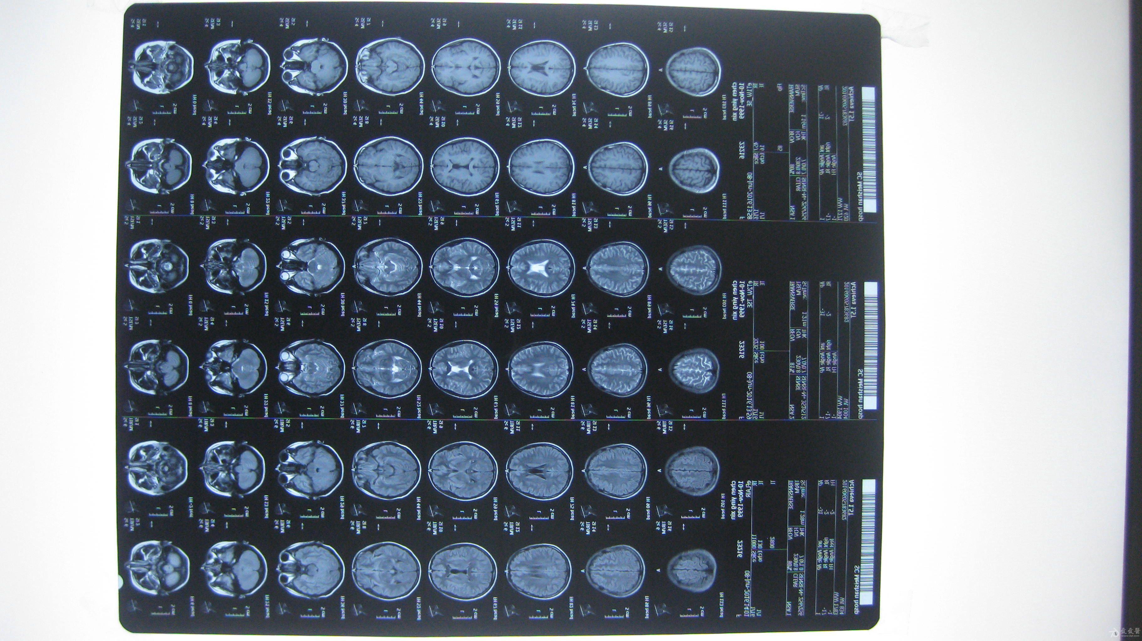 16岁少女脑萎缩