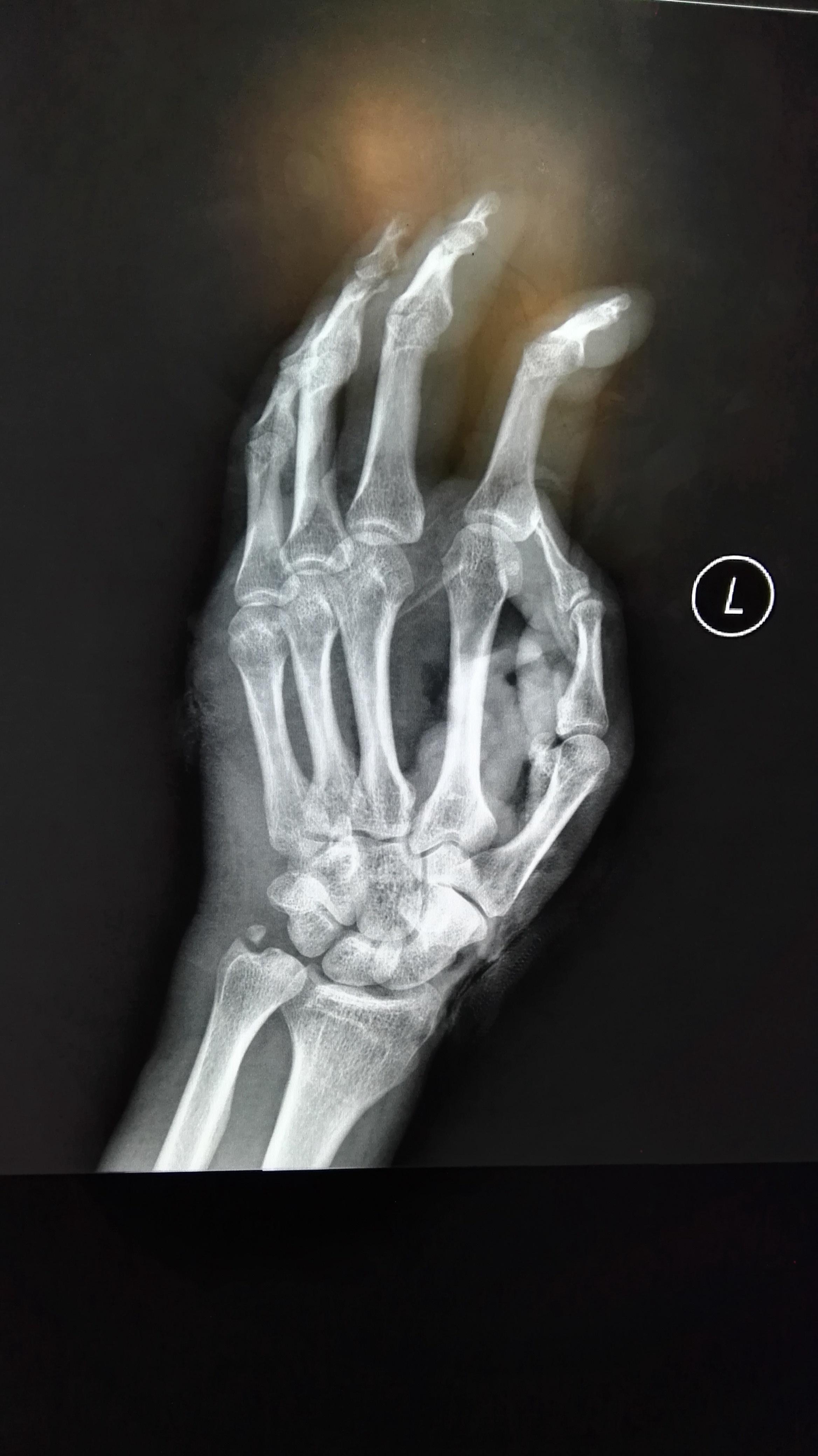 腕关节外伤请大家下准确诊断