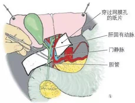 24 肝十②指肠韧带内的解剖结构.图中的纸片穿过网膜孔