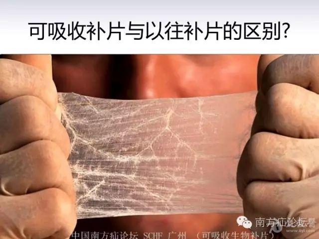 谈生物补片