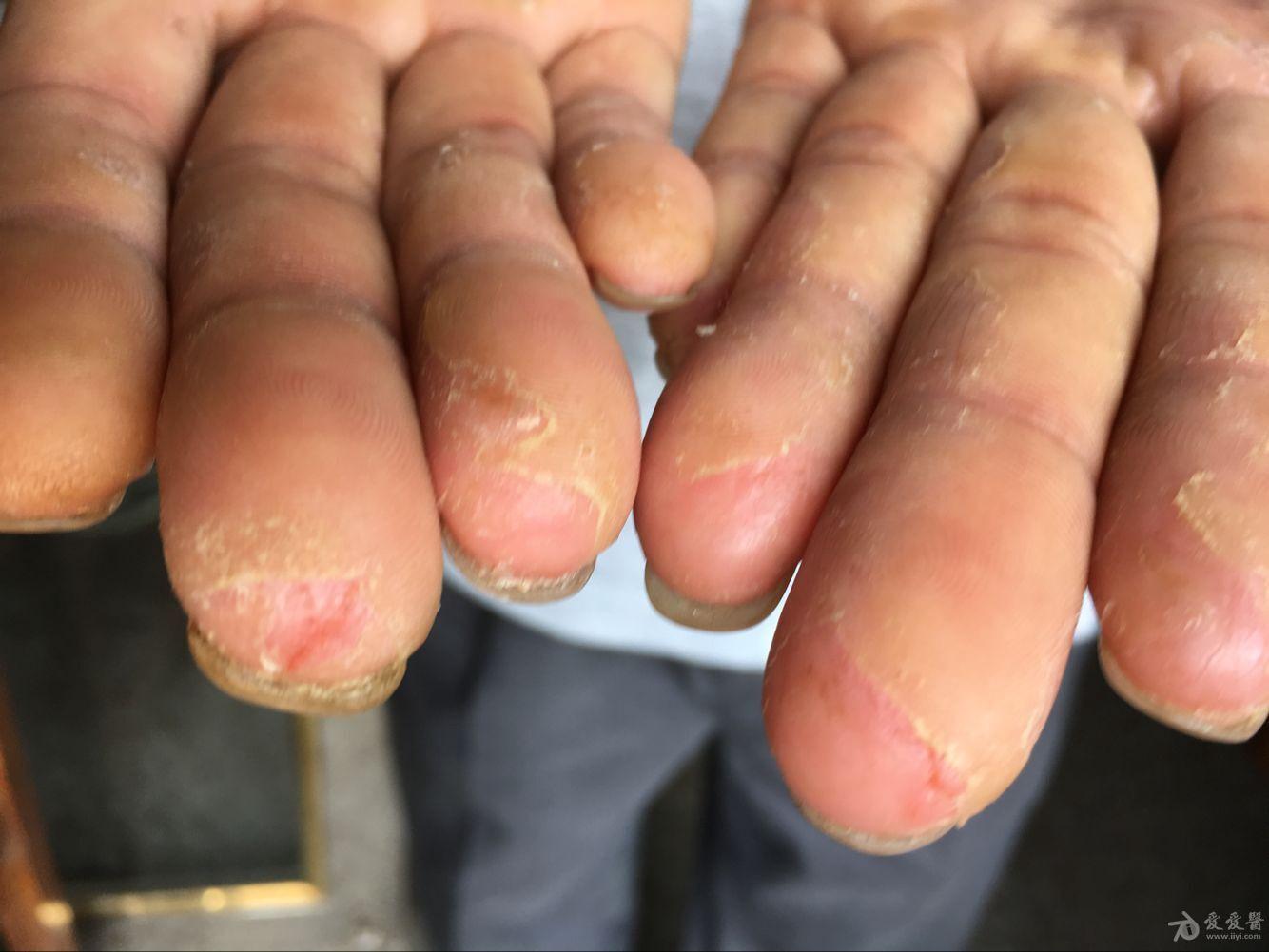 有奖猜图积分大派送十五剥脱性角质松解症