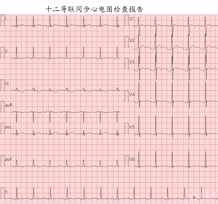 低钾一例 - 心电图脑电图专业讨论版 - 爱爱医医学论坛