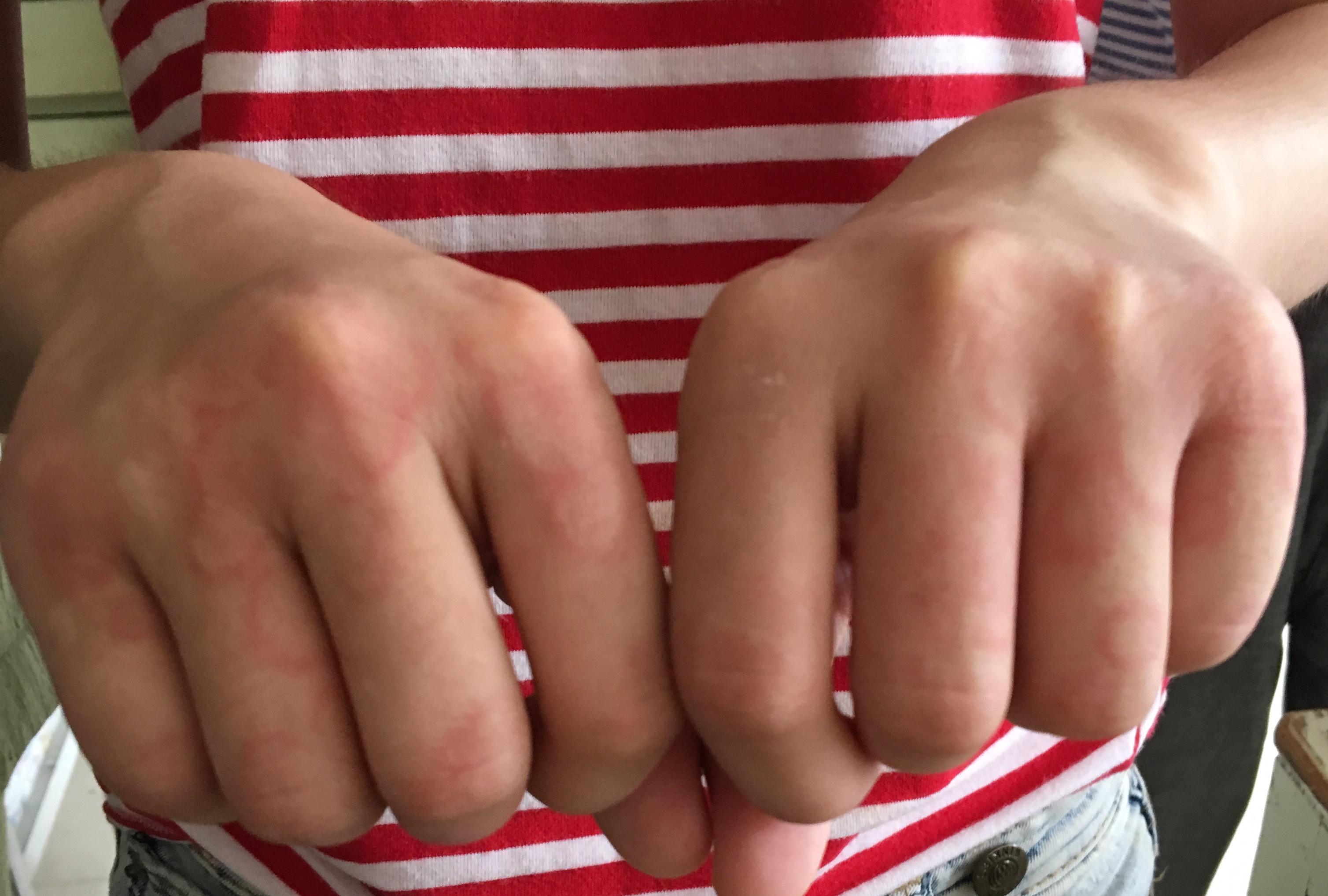 手背手指的红圈圏