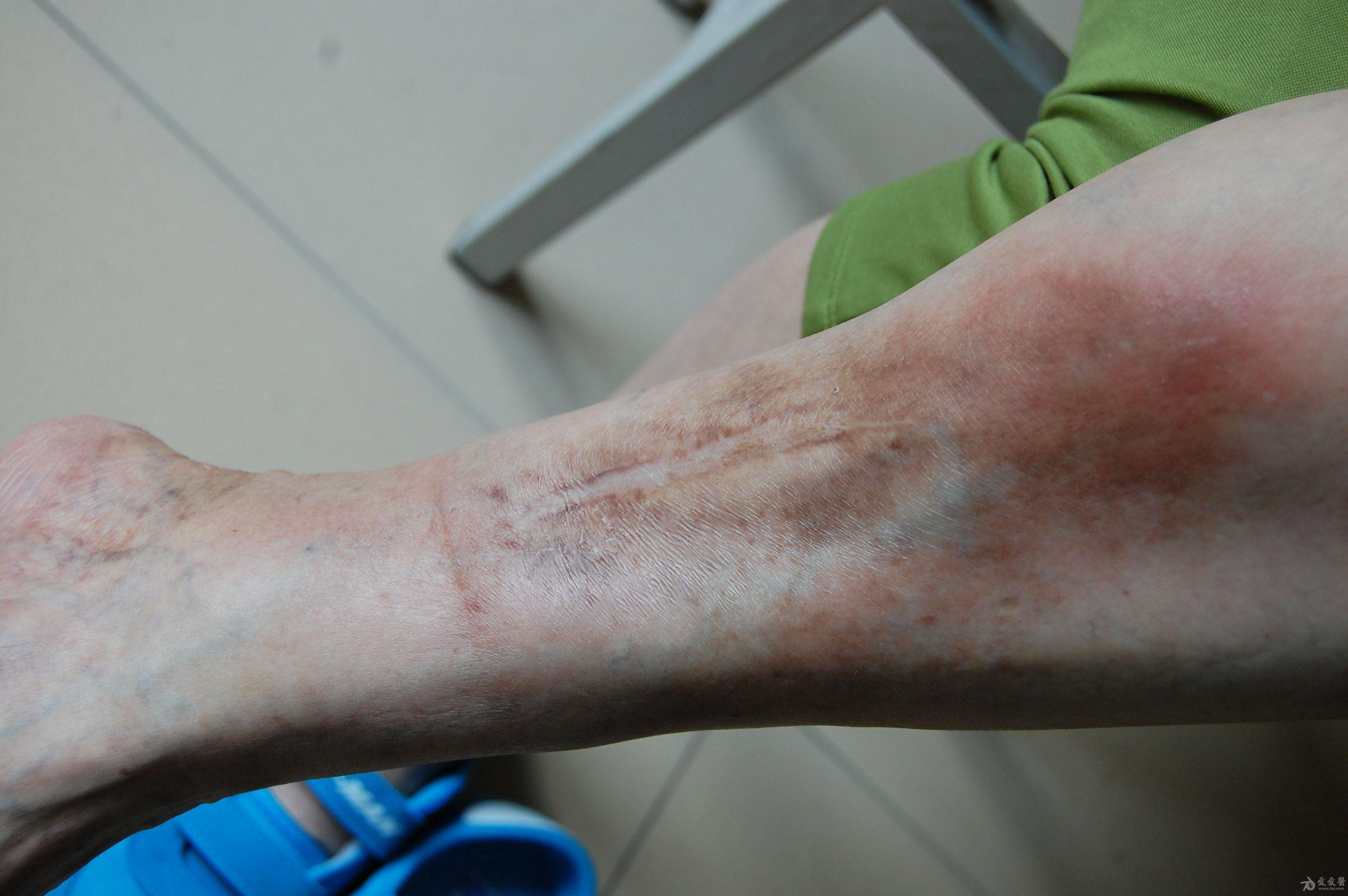 请教大家看下是丹毒还是蜂窝组织炎有照片我错了吗