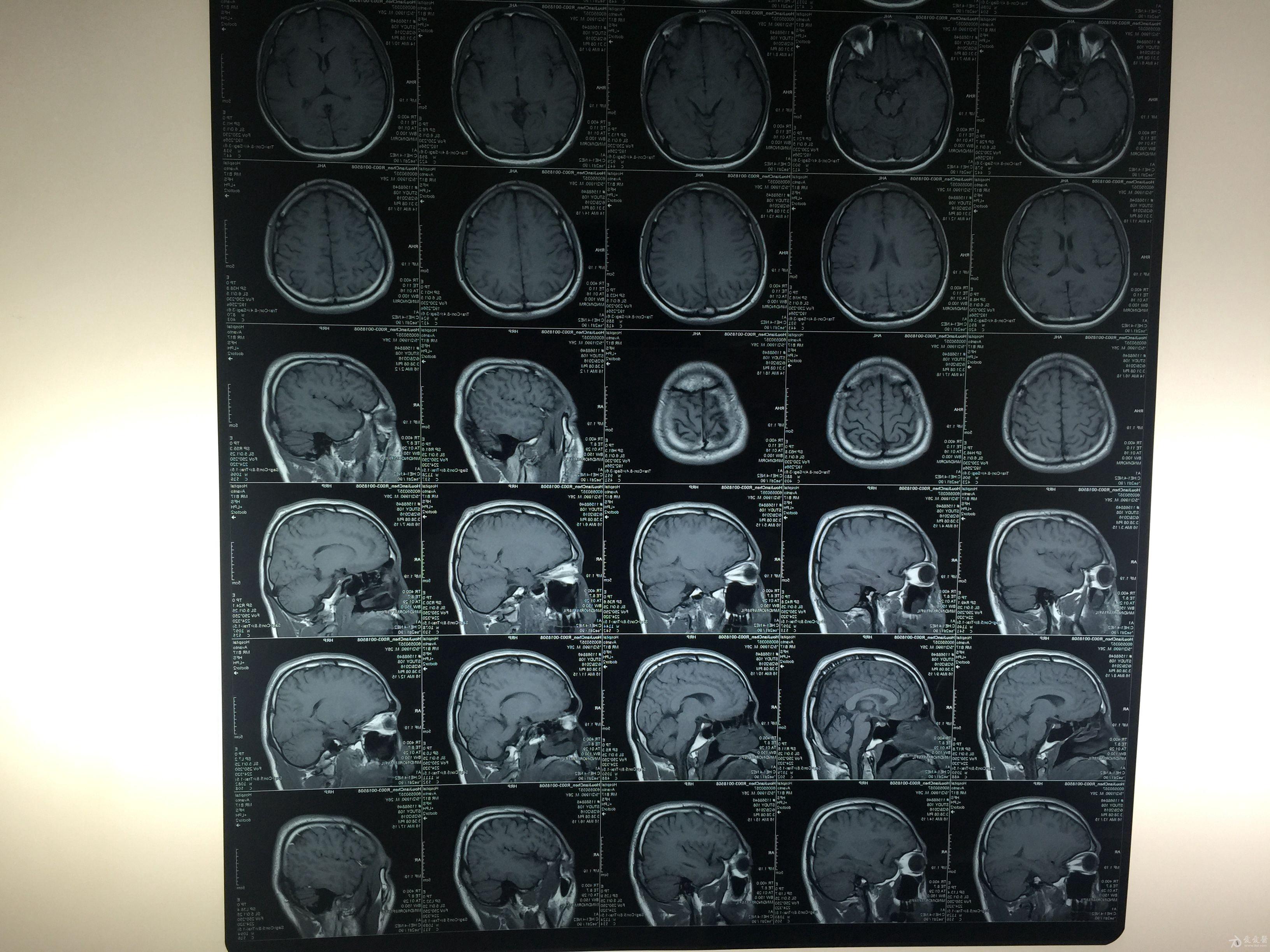 弥漫性轴索损伤相关讨论(原创)