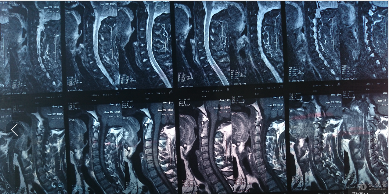 拍了頸椎核磁共振請醫生看看