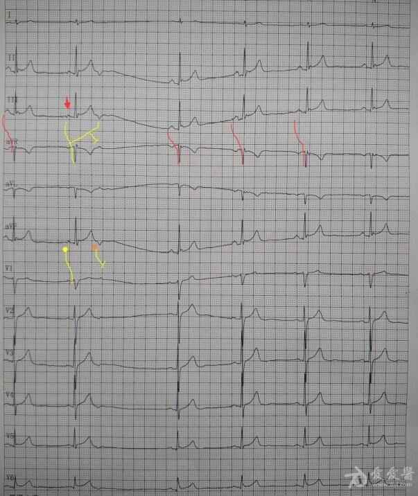房早未下传心电图图片图片