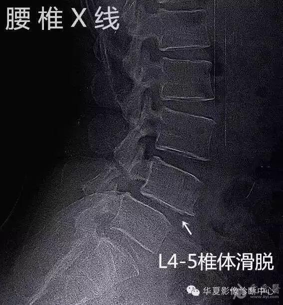 腰椎滑脱分度且看高清图解