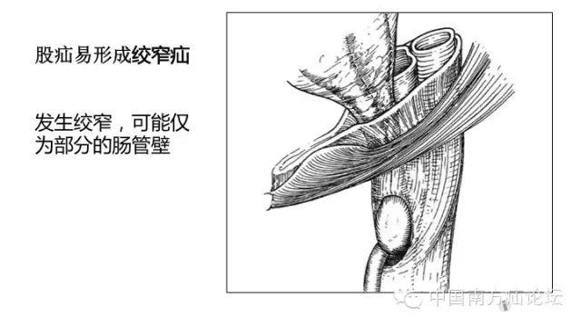 股疝手术要注意的几个方面