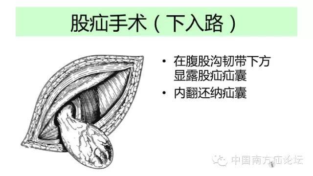 股疝手术步骤图解图片