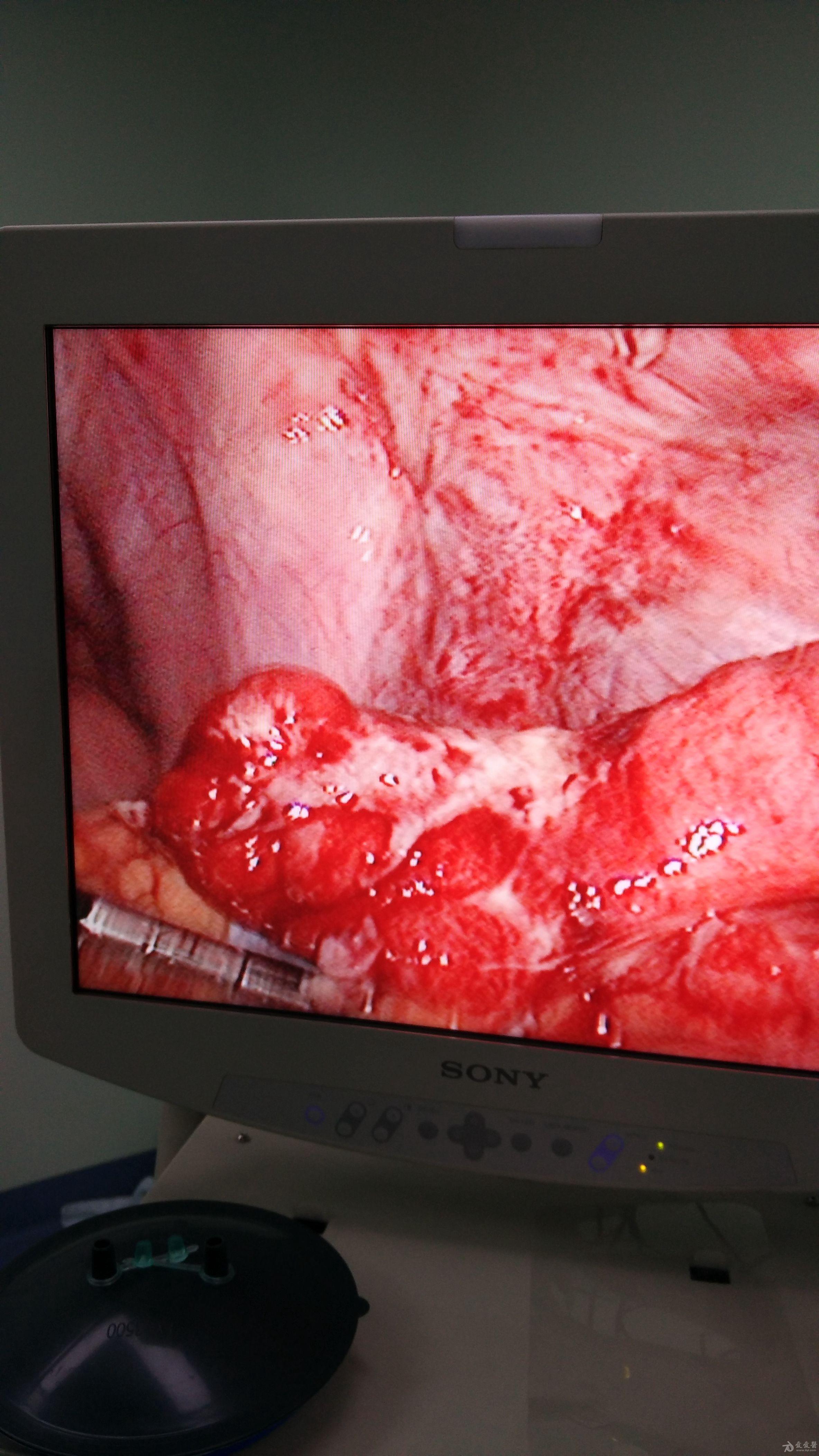 腹腔镜坏疽性阑尾炎切除术