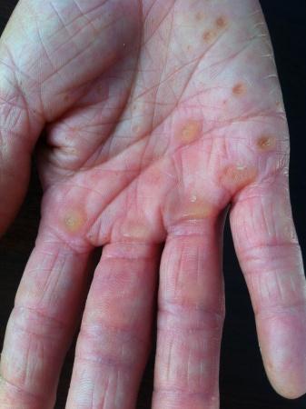 双手足皮损多年 是点状掌跖角皮症 皮肤及性传播疾病讨论版 爱爱医医学论坛