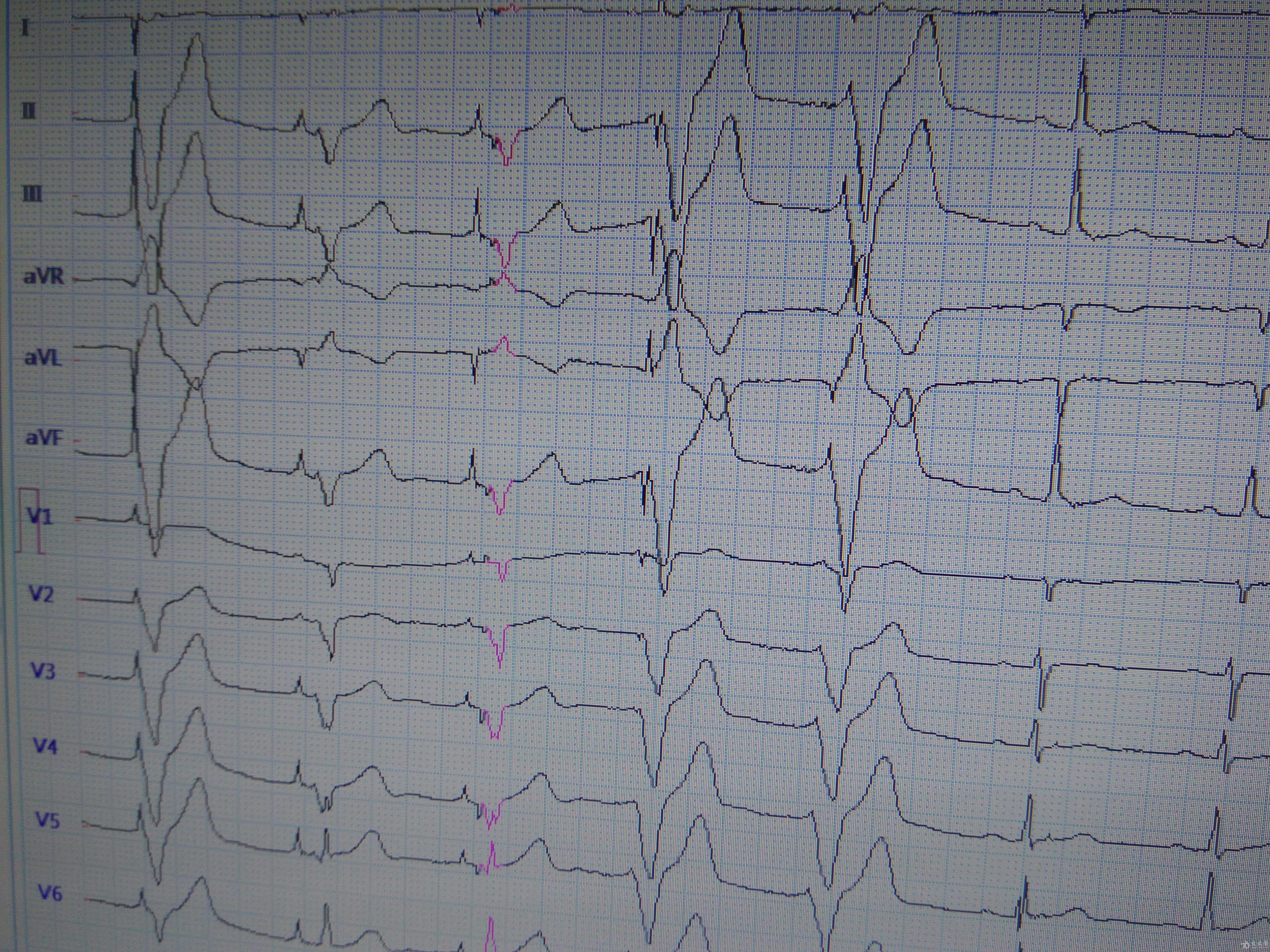 如何分析这份心电图起搏器有问题吗