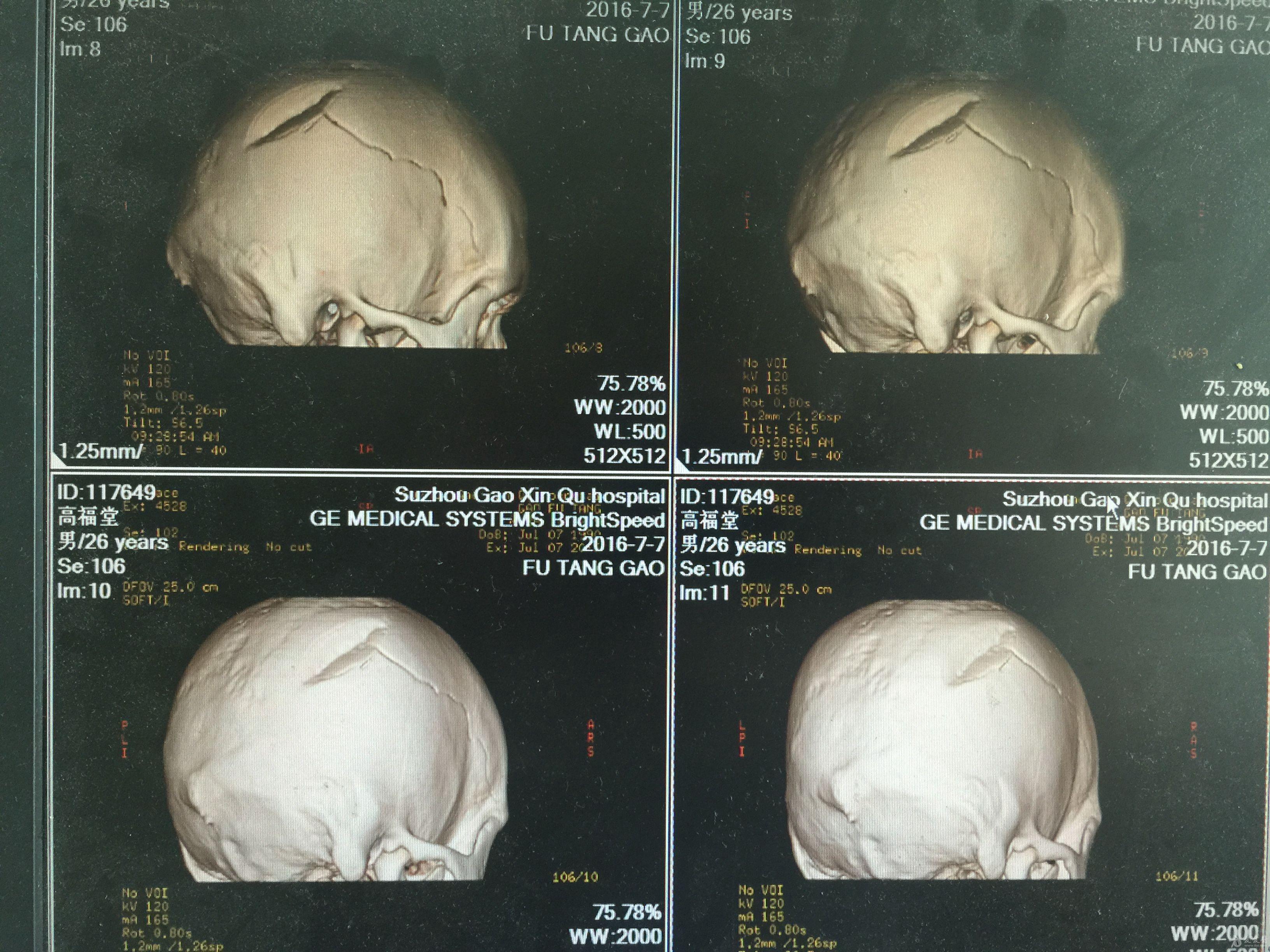 颅底骨折临床表现图片