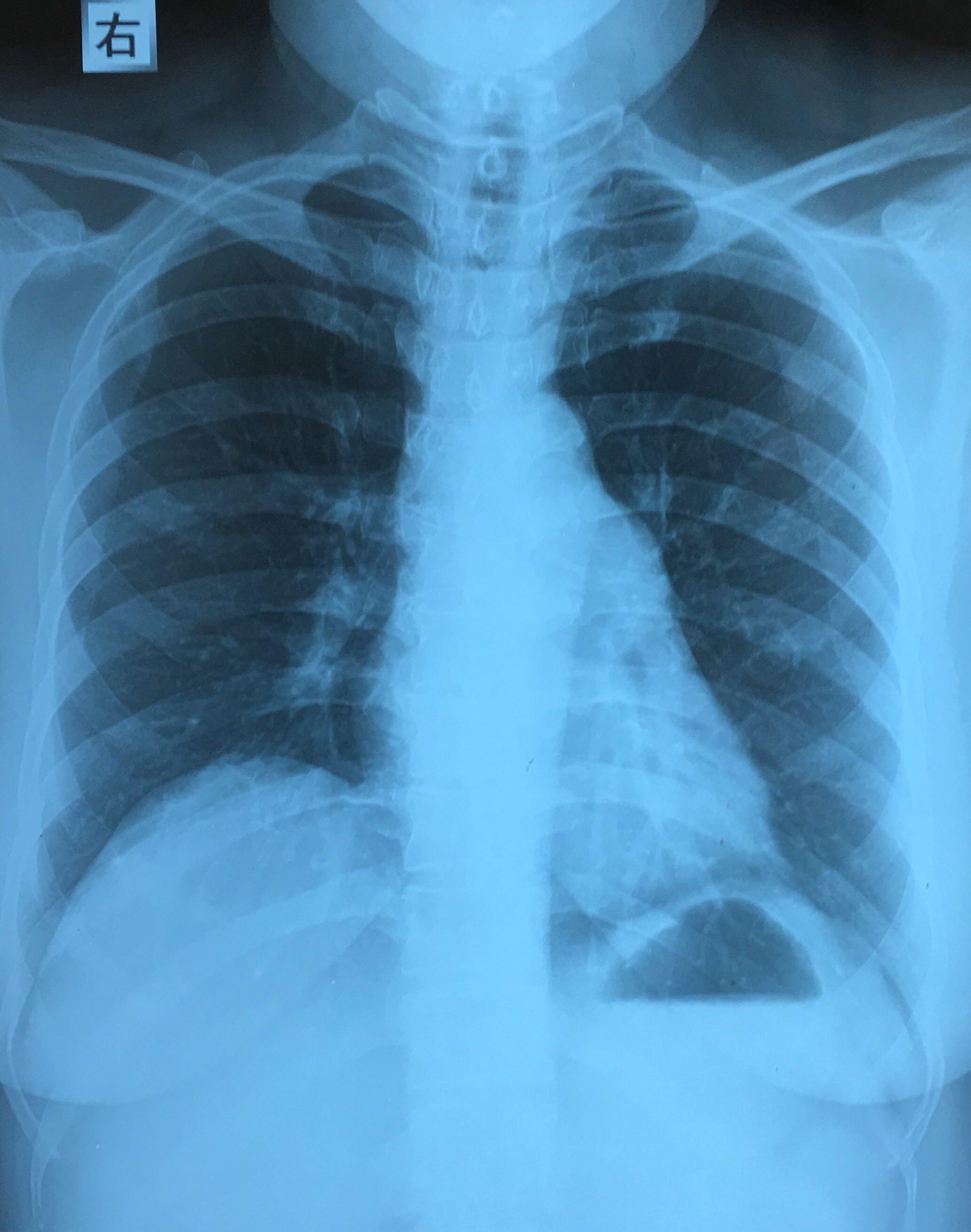 肺动脉段膨隆图片