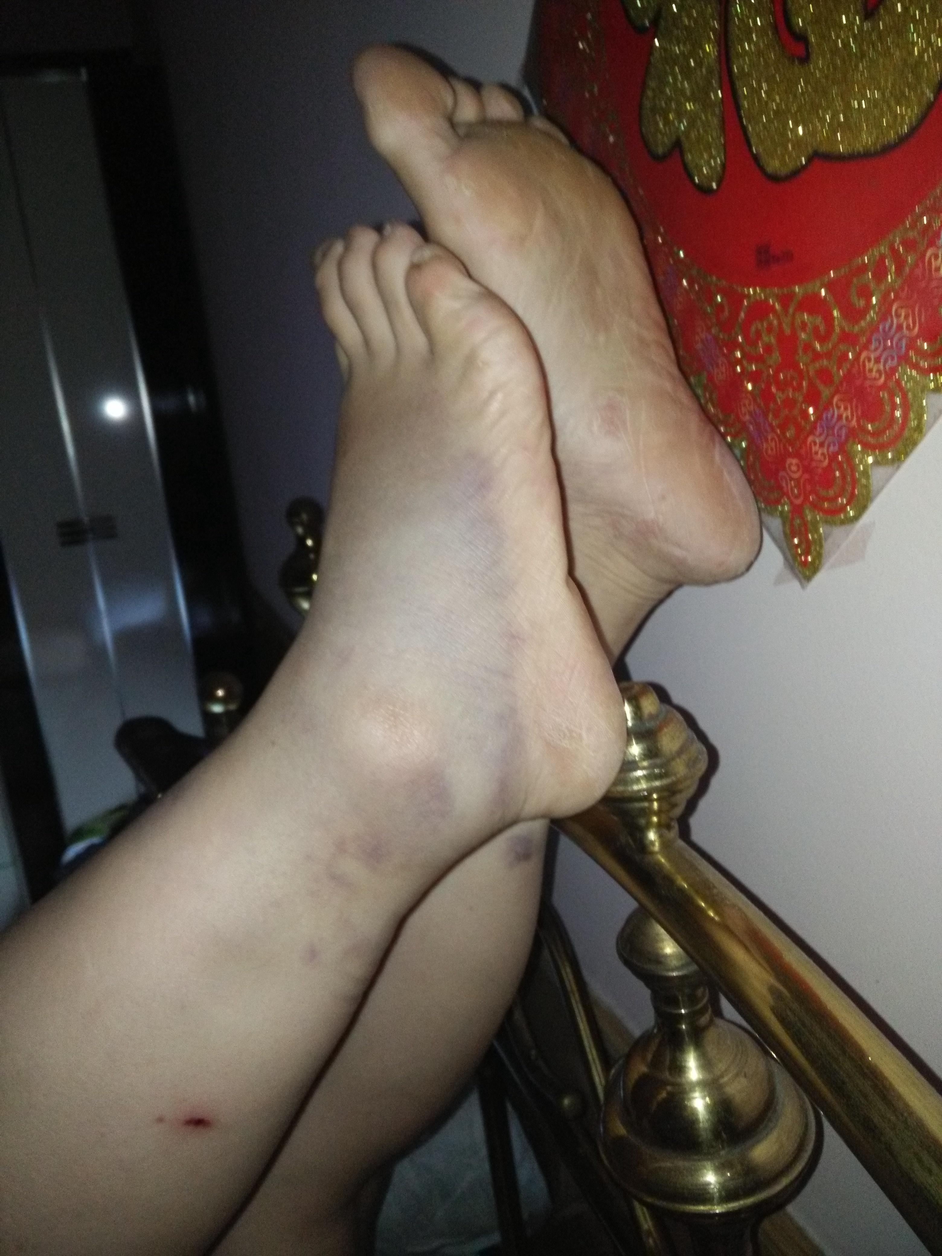 小腿浮肿疼痛散出许多黑青