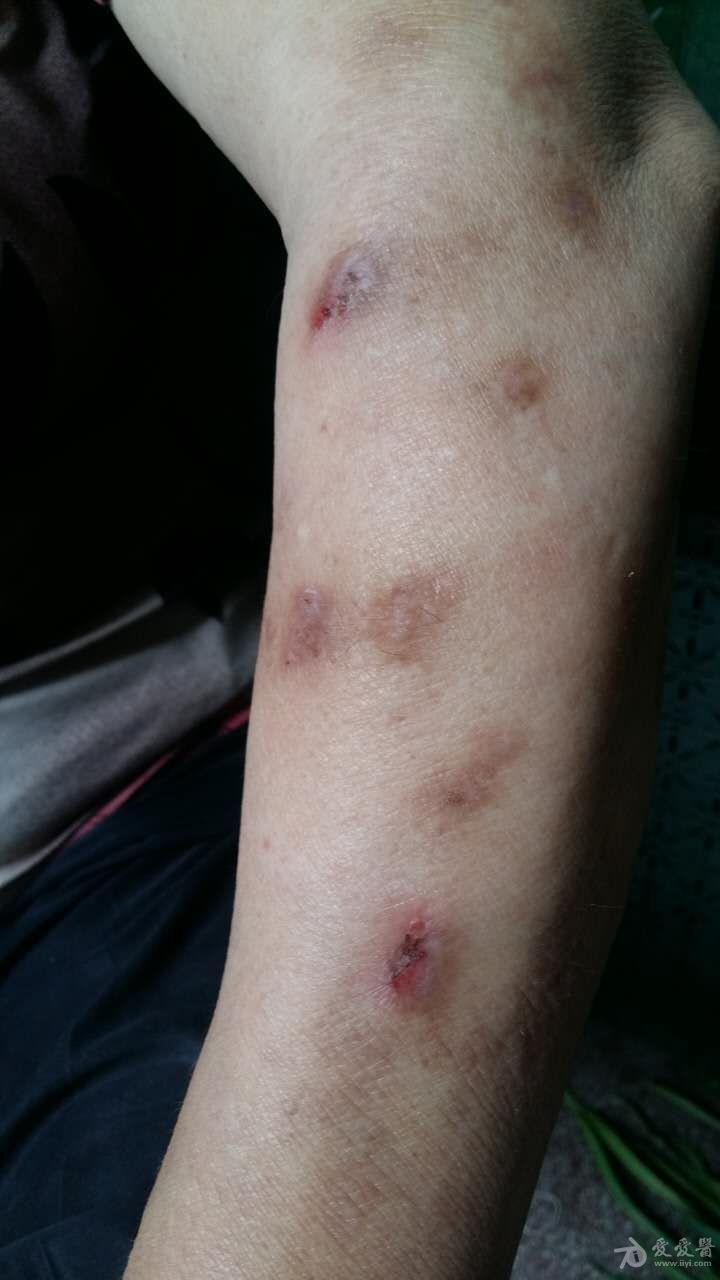 慢性湿疹20年奇痒满身挠的血痕