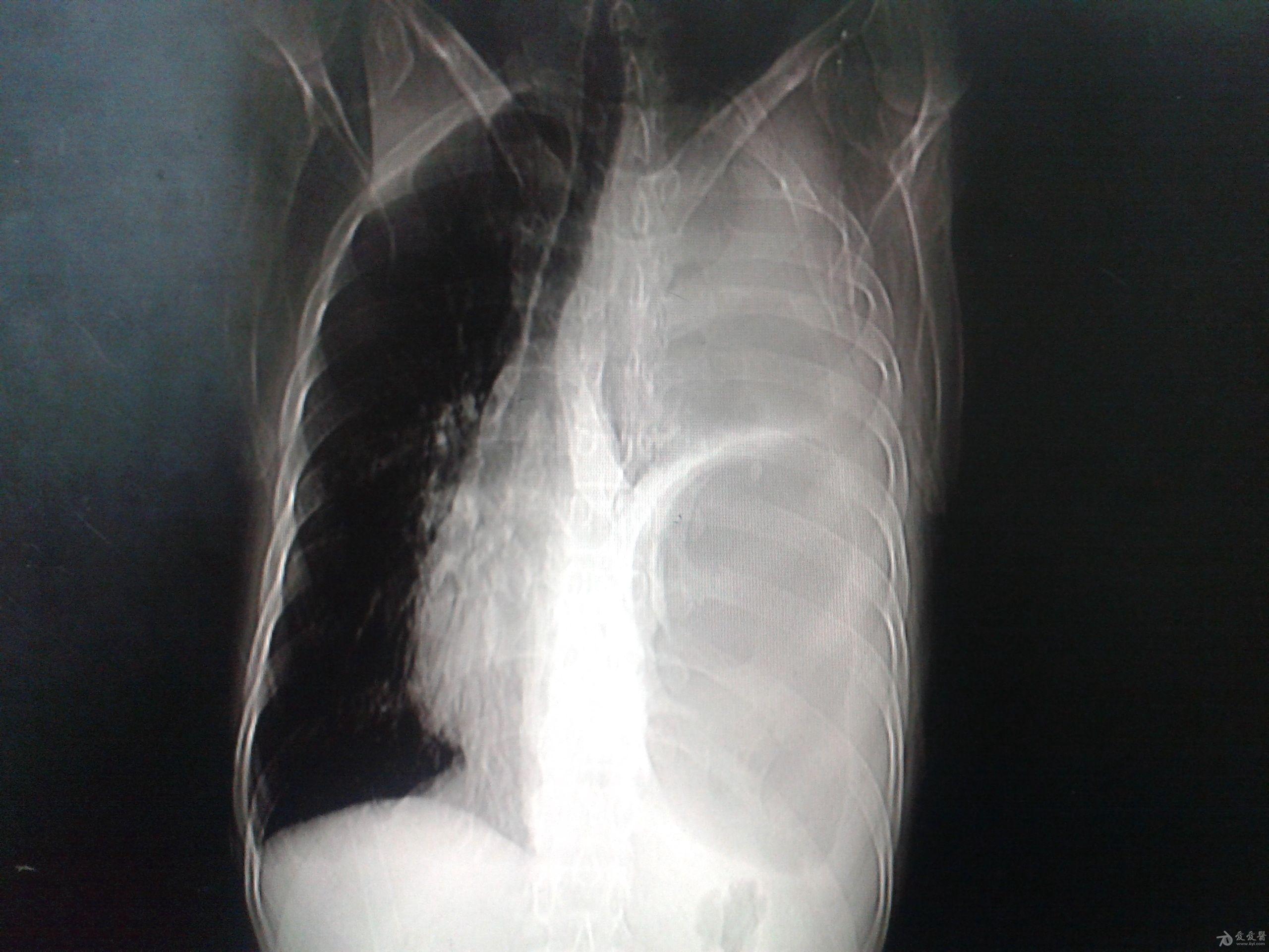 胸腔积液ct图图片
