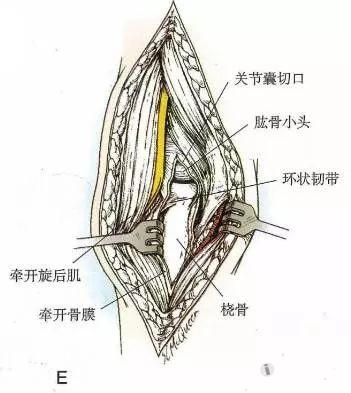 孟氏骨折解剖图图片