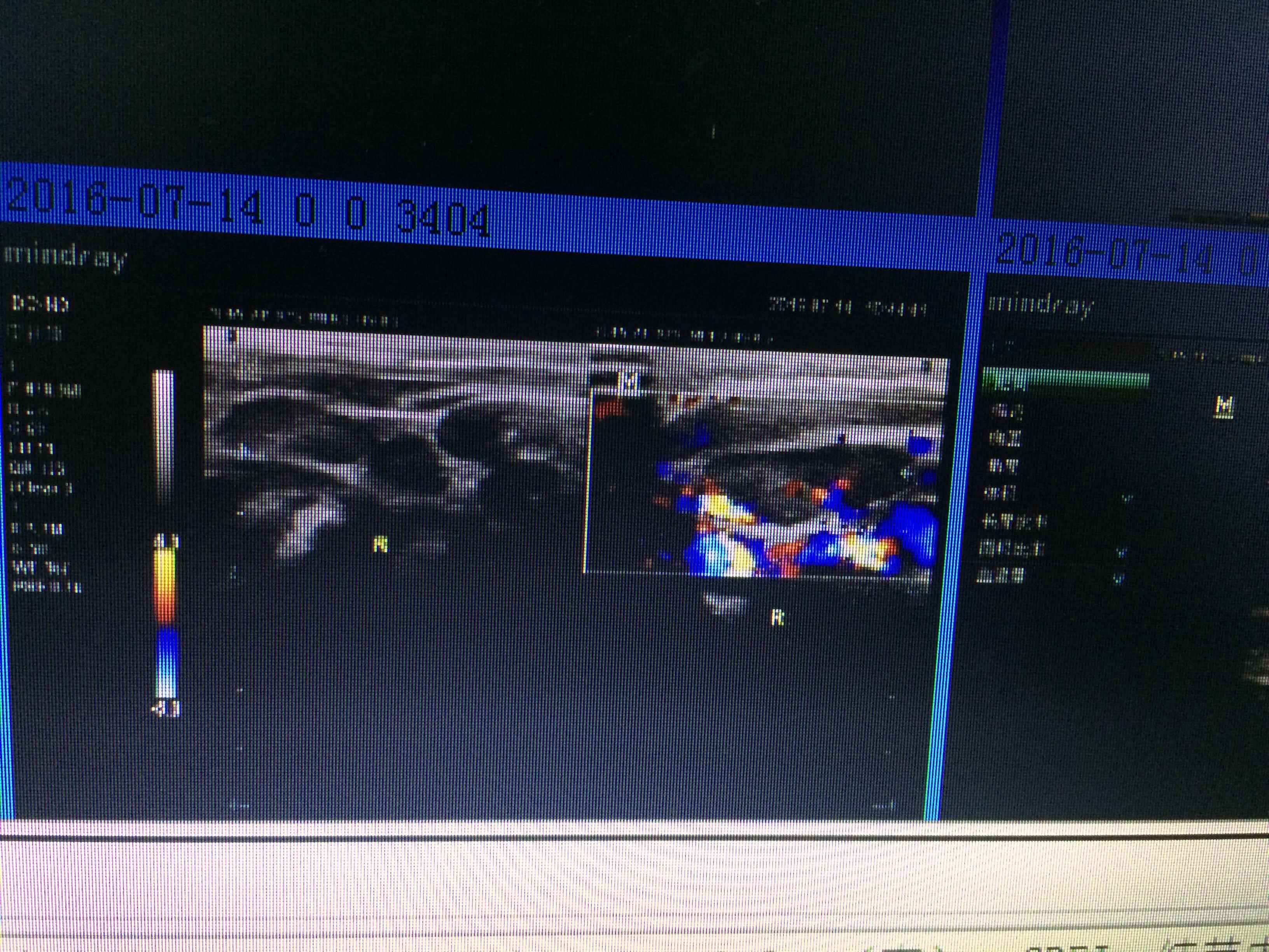小儿颌下及颈部淋巴结肿大,考虑什么 - 超声医学讨论版 - 爱爱医医学