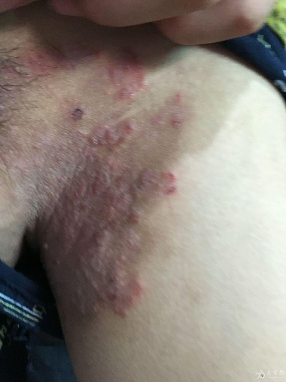 什么是神经性皮炎图 160722192915ubusdsodpabouuof.jpg