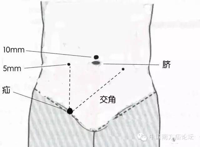 腹股沟具体位置图片